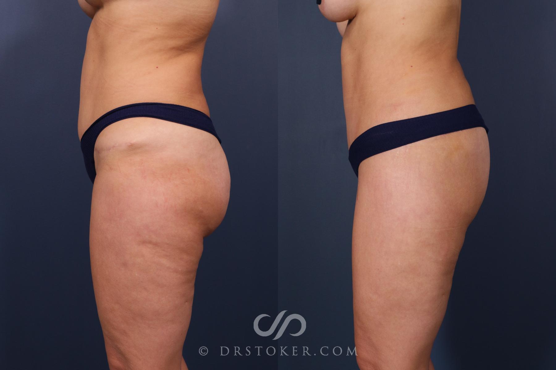Before & After Bikini Body Lift ™ Case 2481 Left Side View in Los Angeles, CA