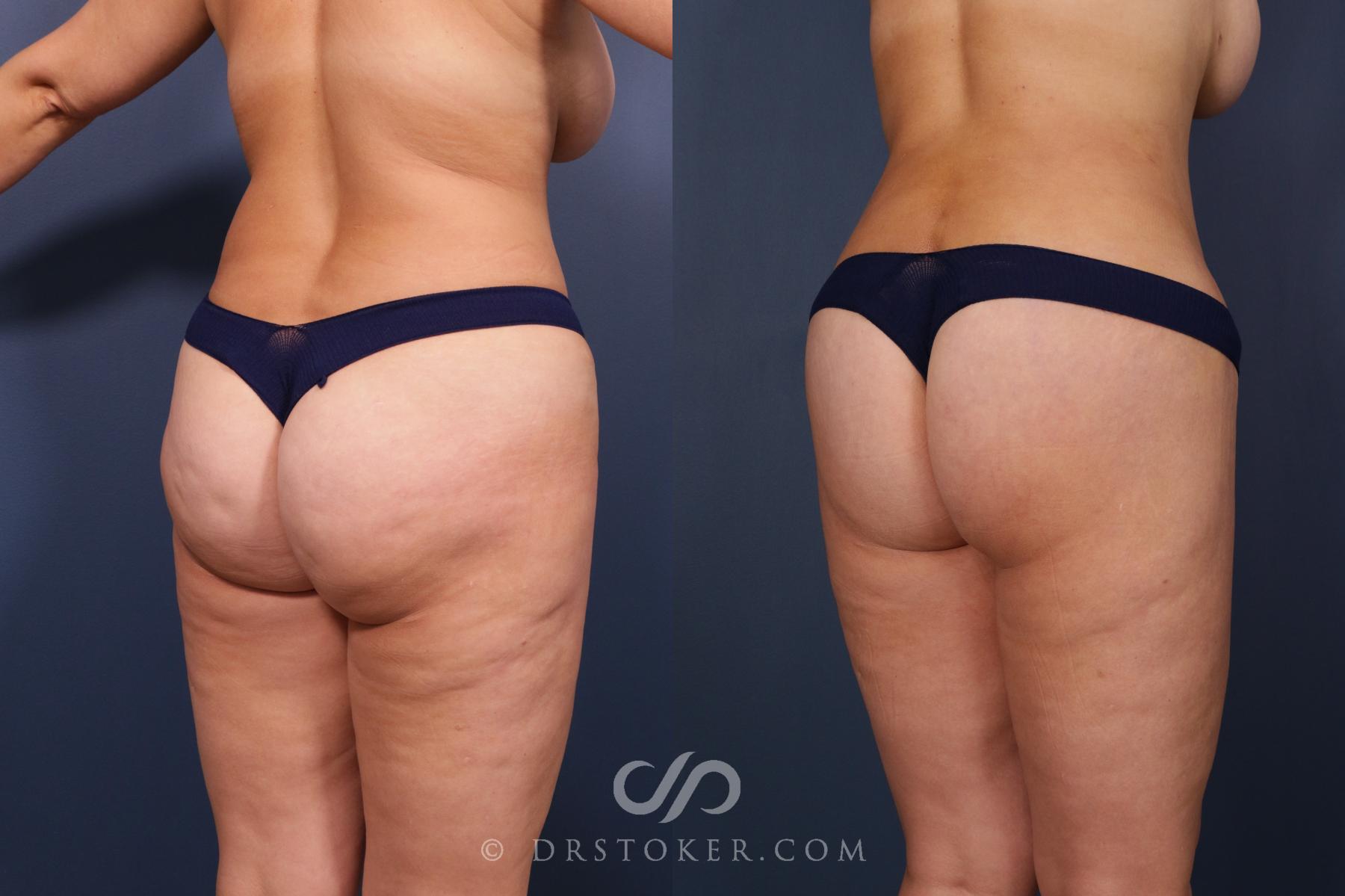 Before & After Bikini Body Lift ™ Case 2481 Right Oblique View in Los Angeles, CA
