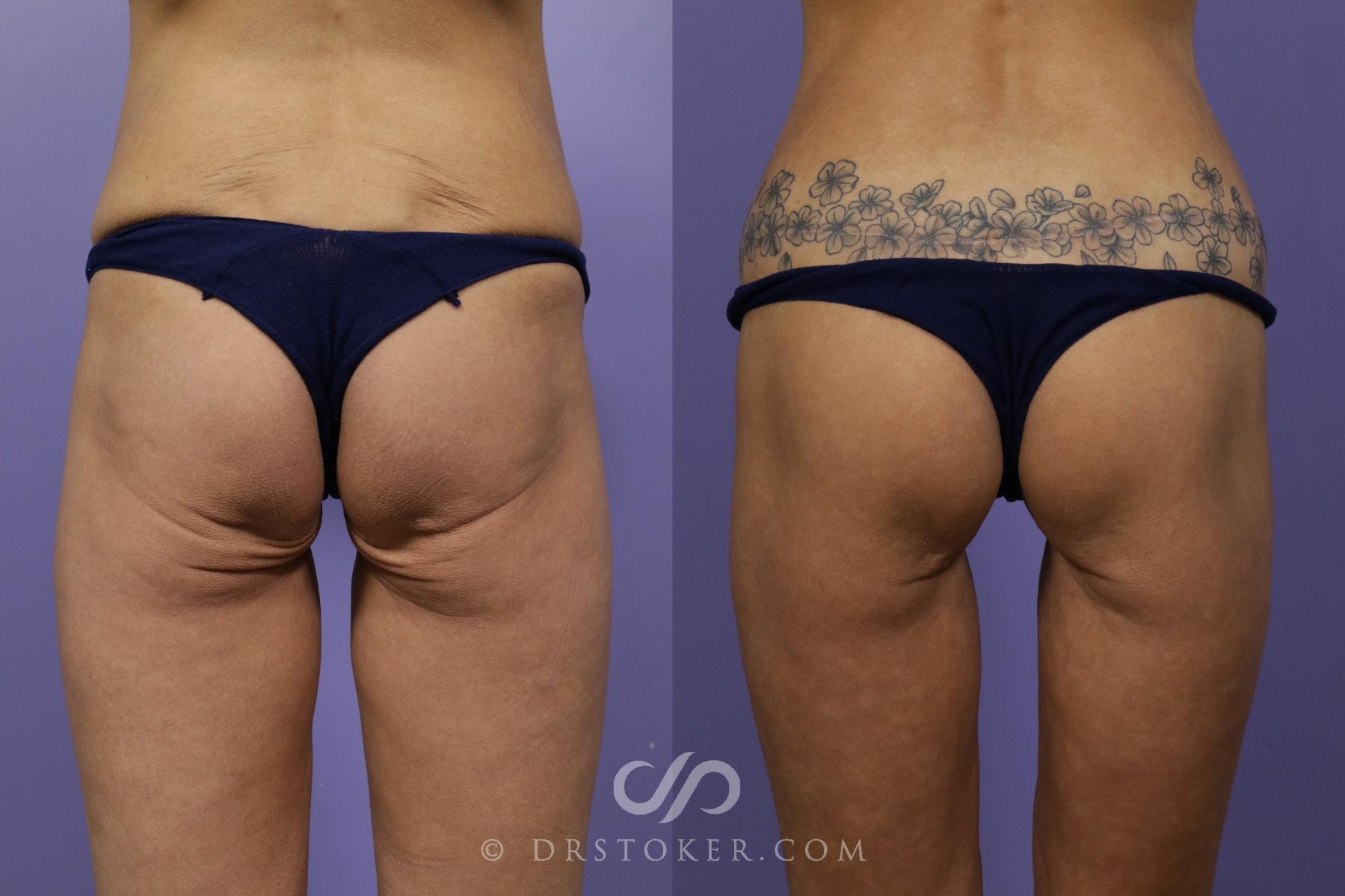 Before & After Bikini Body Lift ™ Case 2482 Back View in Los Angeles, CA