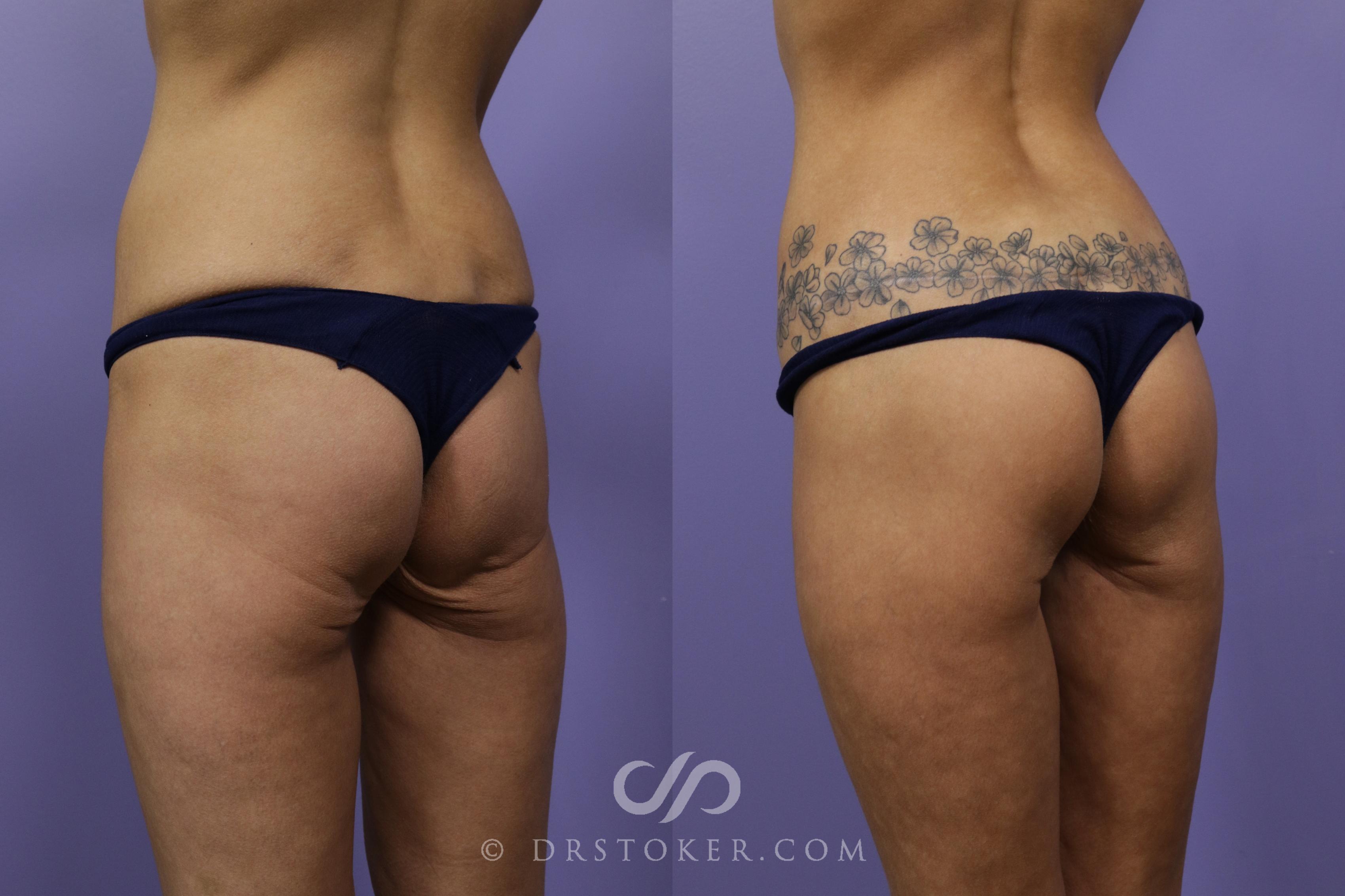 Before & After Bikini Body Lift ™ Case 2482 Left Oblique View in Los Angeles, CA