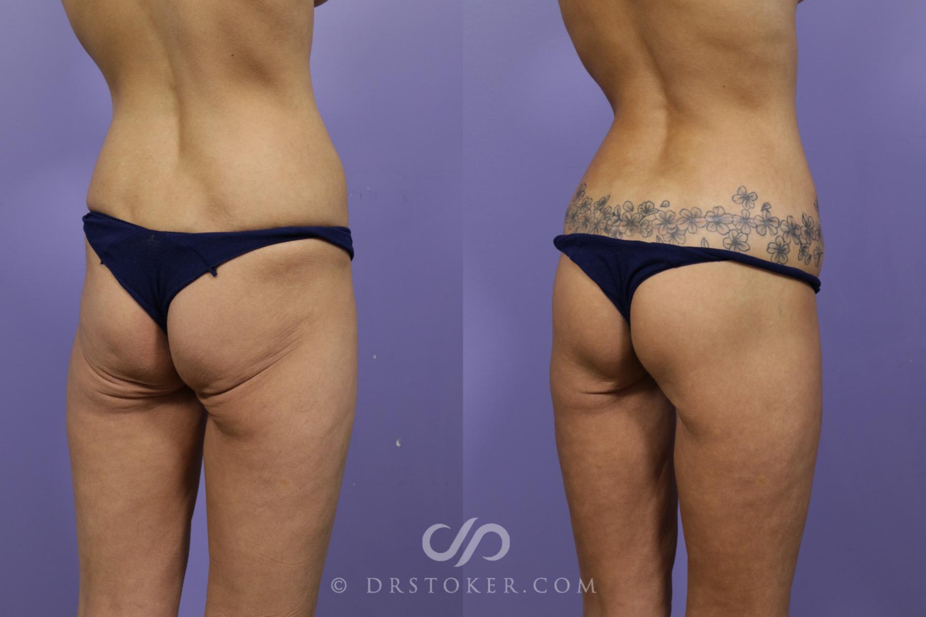 Before & After Bikini Body Lift ™ Case 2482 Right Oblique View in Los Angeles, CA