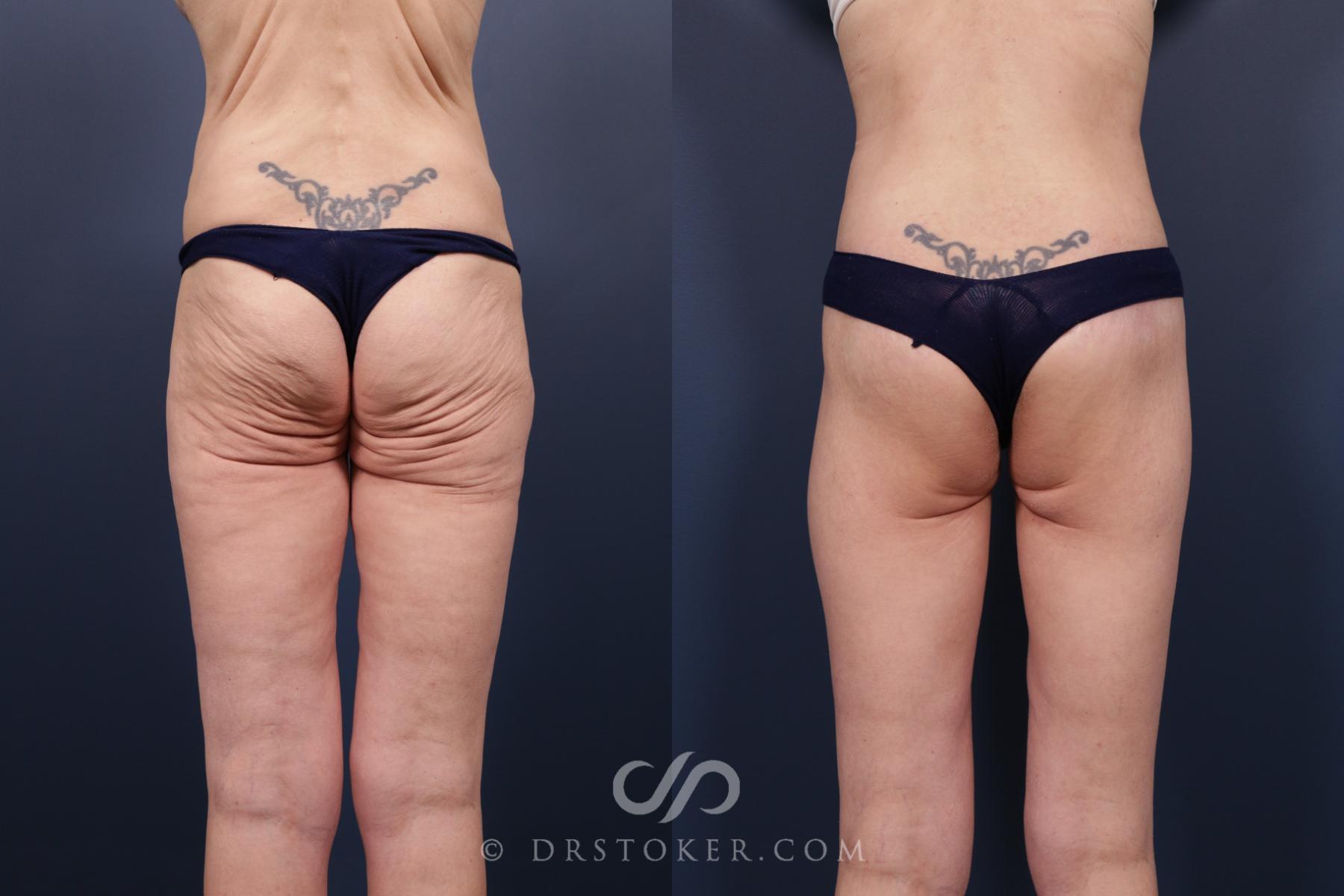 Before & After Bikini Body Lift ™ Case 2484 Back View in Los Angeles, CA