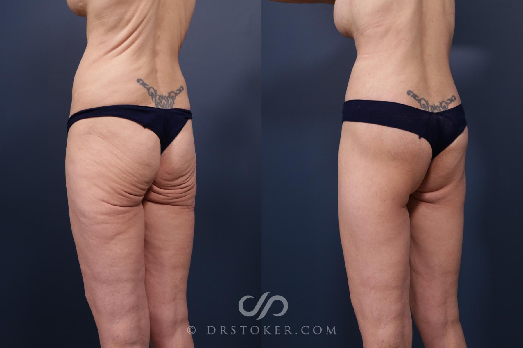 Before & After Bikini Body Lift ™ Case 2484 Left Oblique View in Los Angeles, CA