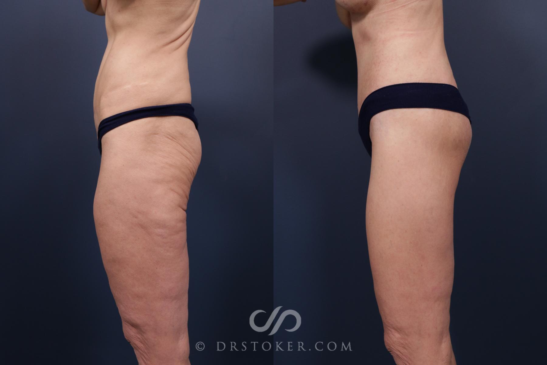 Before & After Bikini Body Lift ™ Case 2484 Left Side View in Los Angeles, CA
