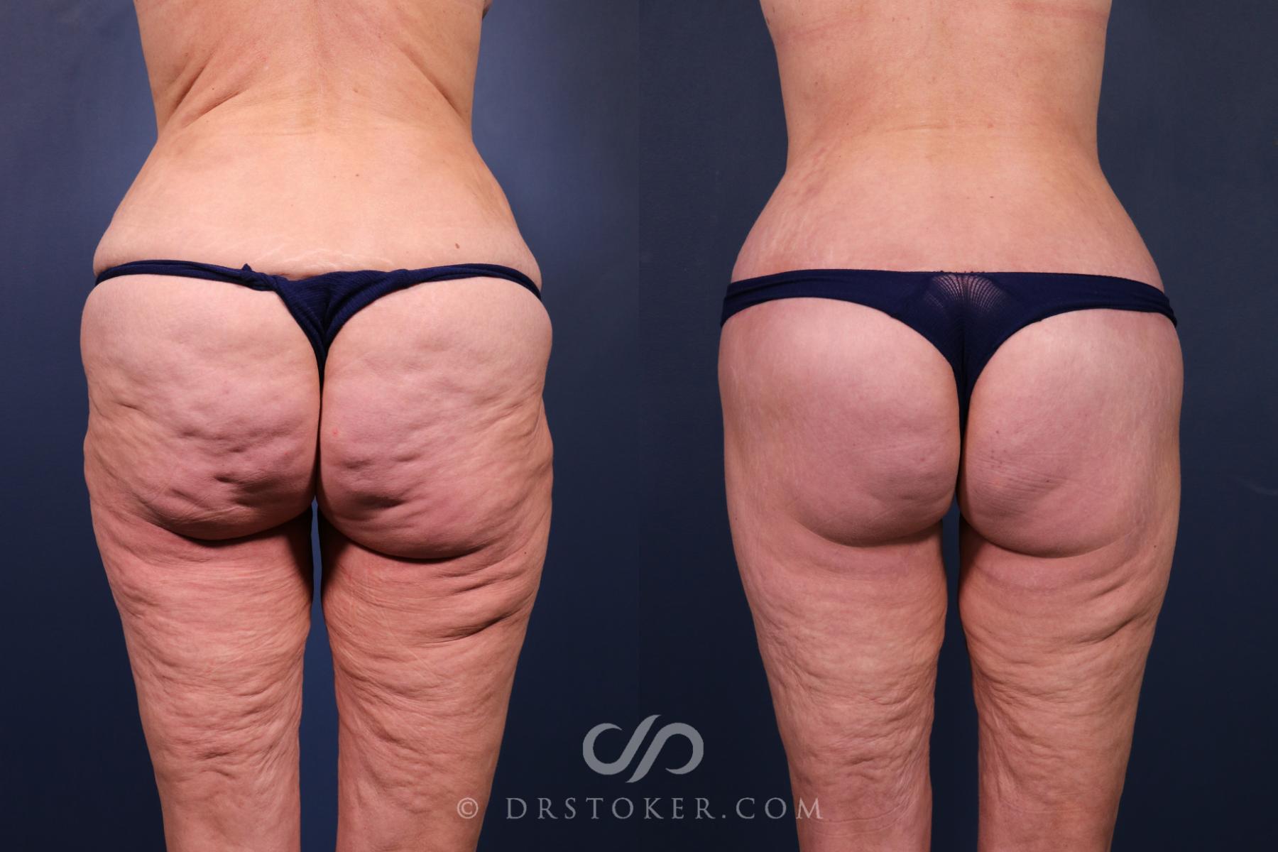Before & After Bikini Body Lift ™ Case 2485 Back View in Los Angeles, CA