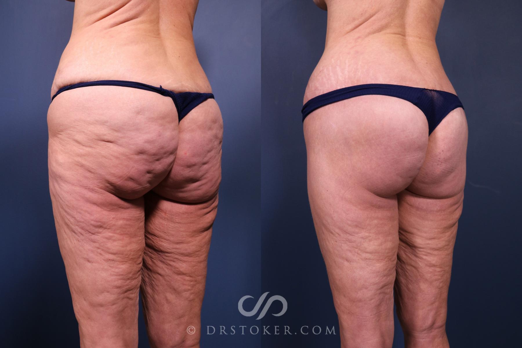 Before & After Bikini Body Lift ™ Case 2485 Left Oblique View in Los Angeles, CA