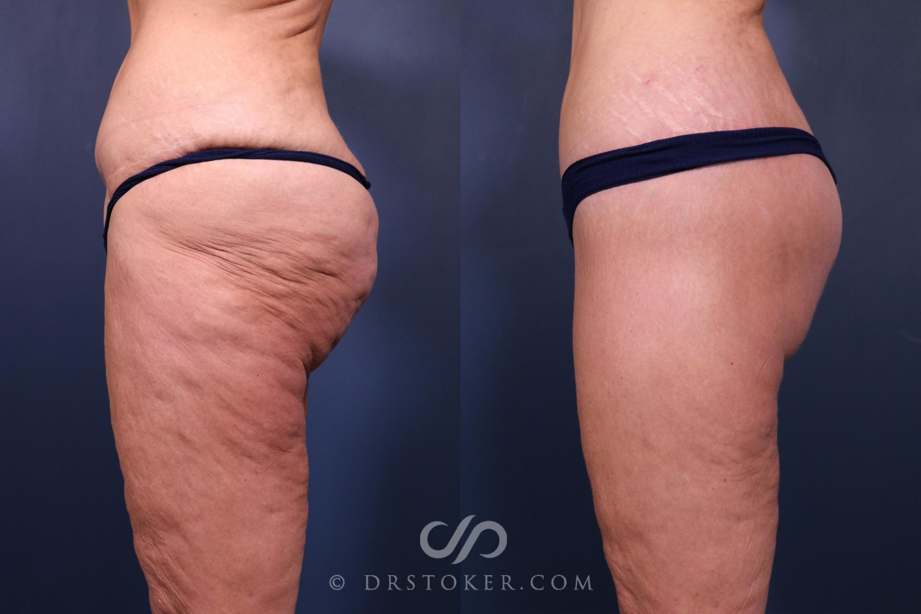 Before & After Bikini Body Lift ™ Case 2485 Left Side View in Los Angeles, CA