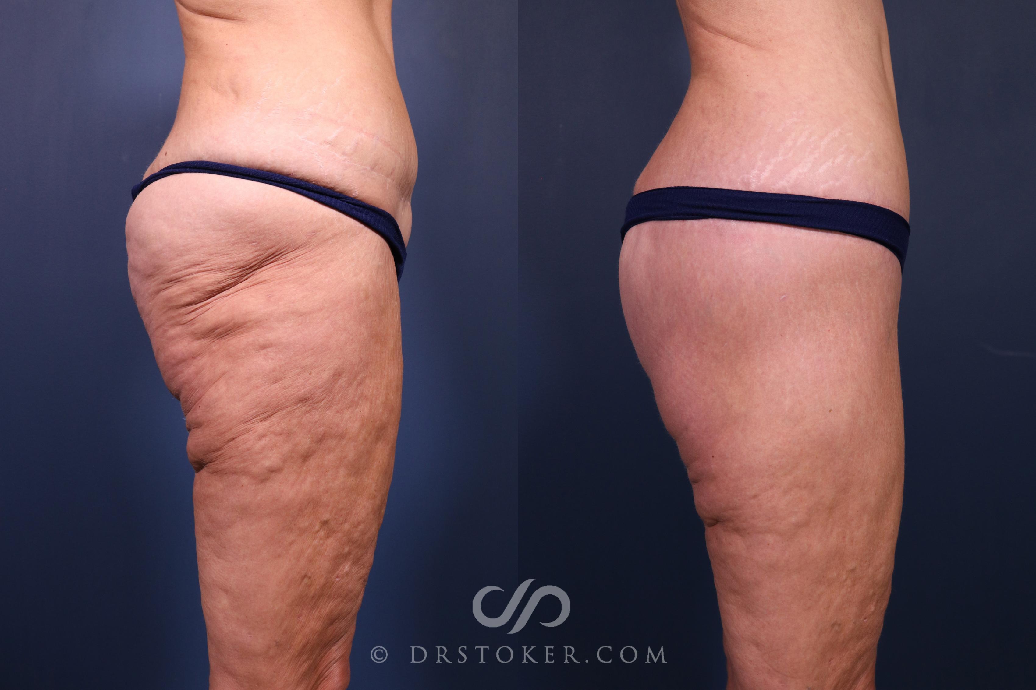 Before & After Bikini Body Lift ™ Case 2486 Right Side View in Los Angeles, CA