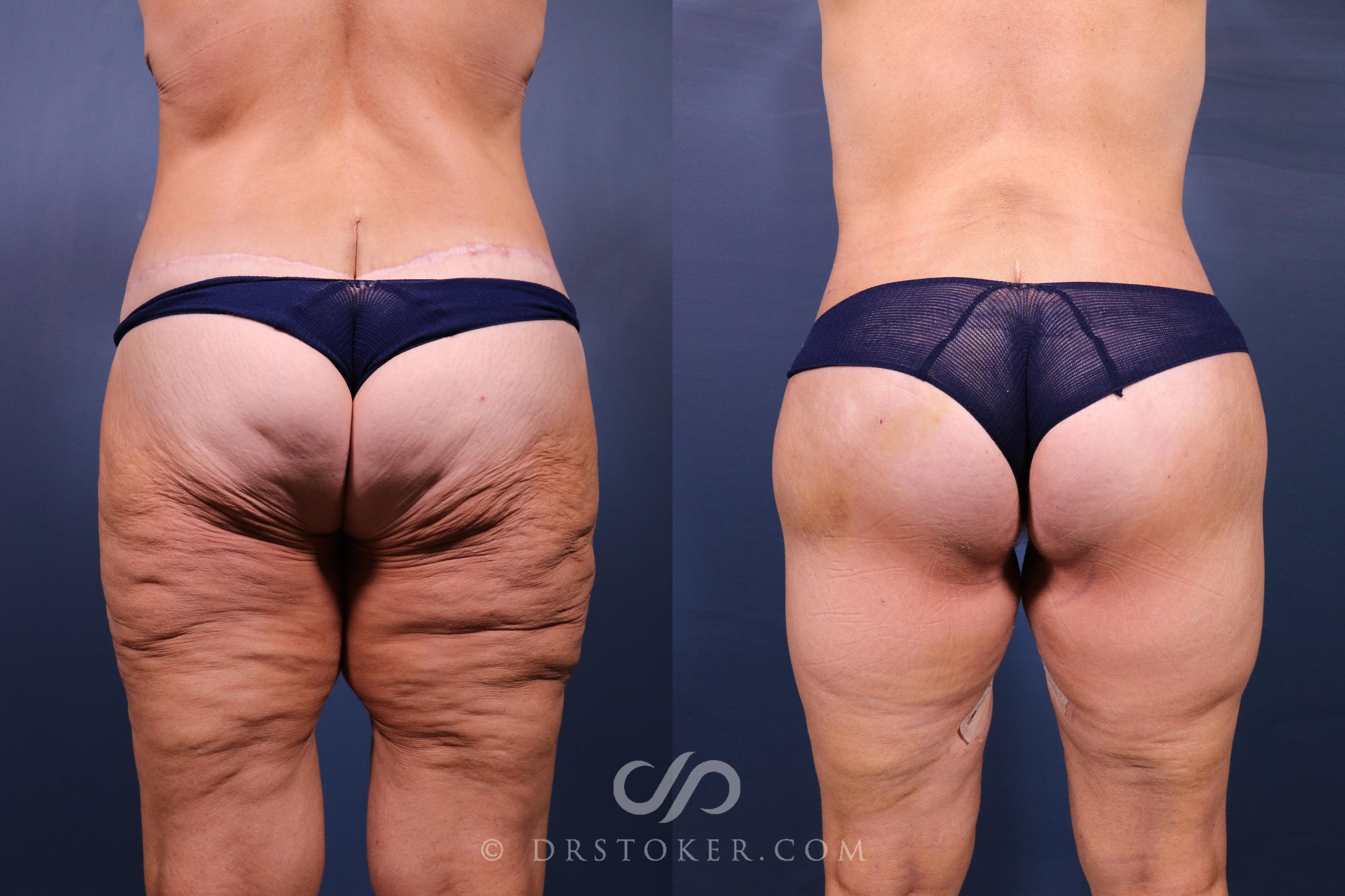 Before & After Bikini Body Lift ™ Case 2487 Back View in Los Angeles, CA