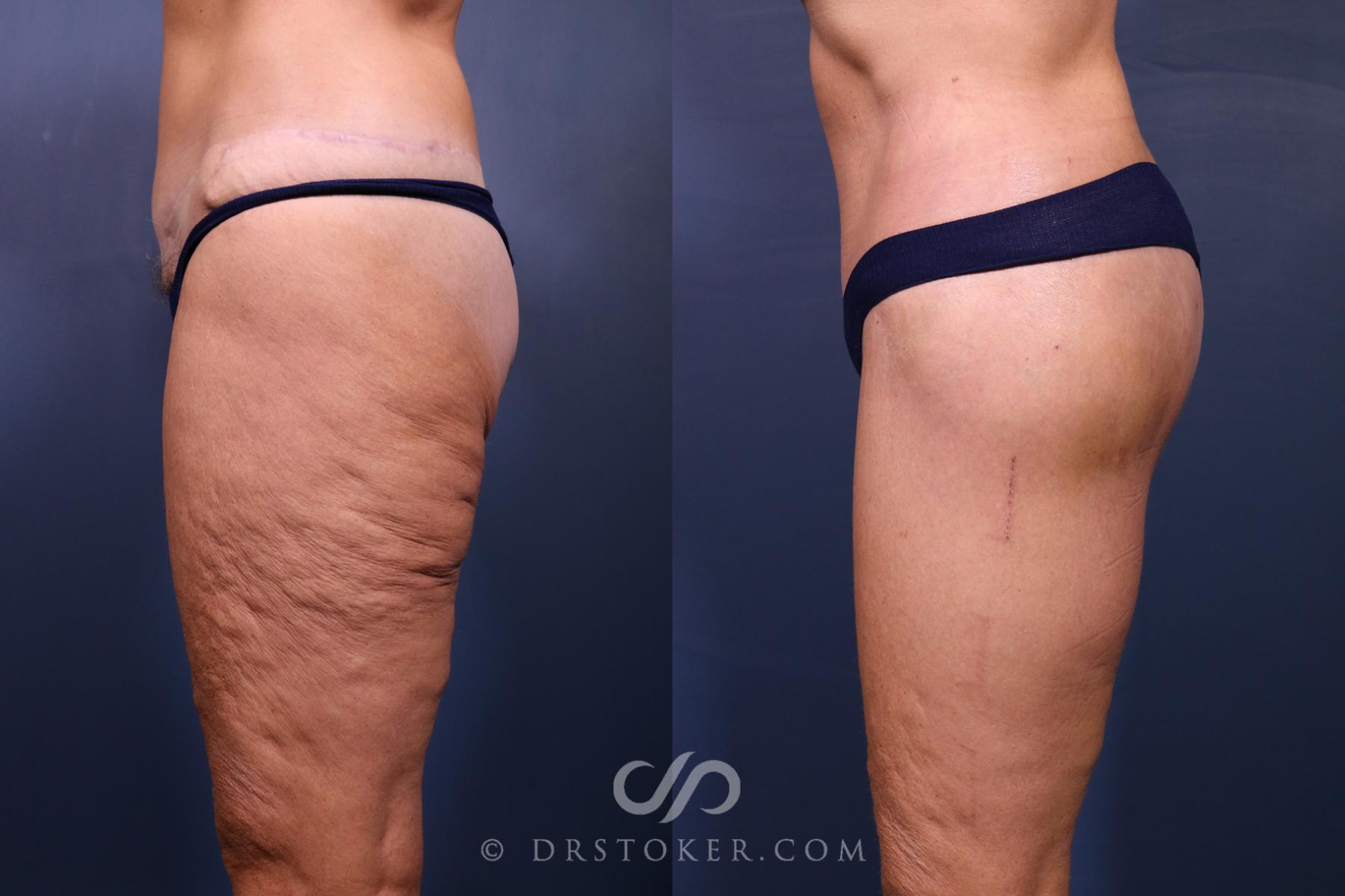 Before & After Bikini Body Lift ™ Case 2487 Left Side View in Los Angeles, CA