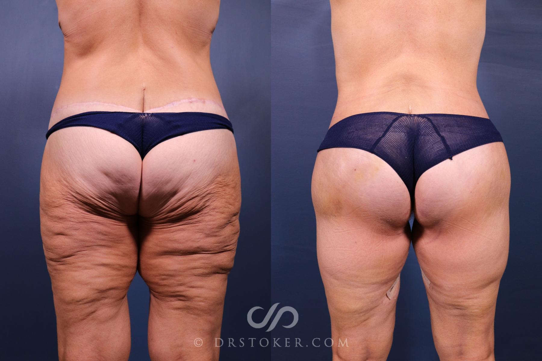 Before & After Bikini Body Lift ™ Case 2488 Back View in Los Angeles, CA
