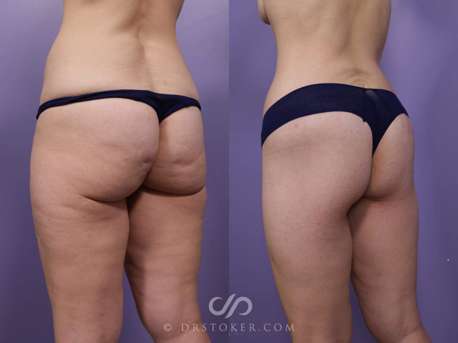 Before & After Bikini Body Lift ™ Case 2503 Left Oblique View in Los Angeles, CA