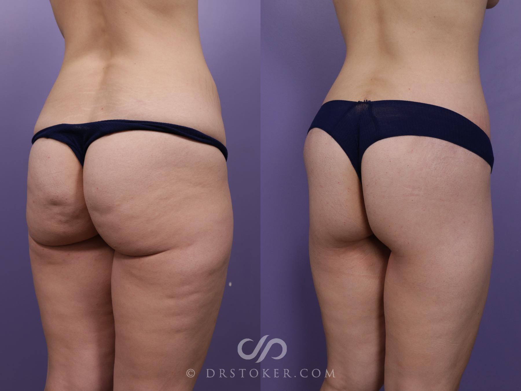 Before & After Bikini Body Lift ™ Case 2503 Right Oblique View in Los Angeles, CA
