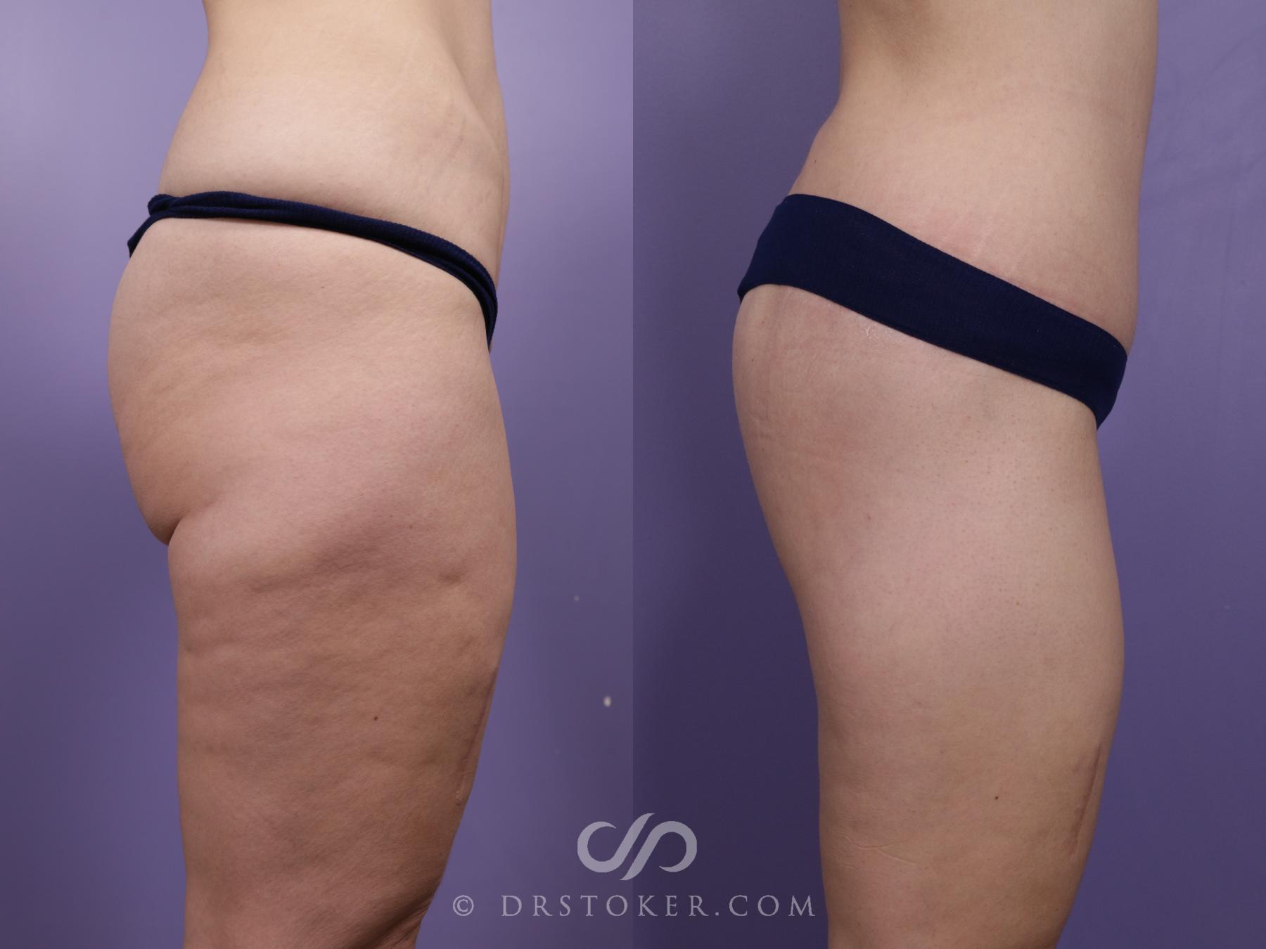 Before & After Bikini Body Lift ™ Case 2503 Right Side View in Los Angeles, CA