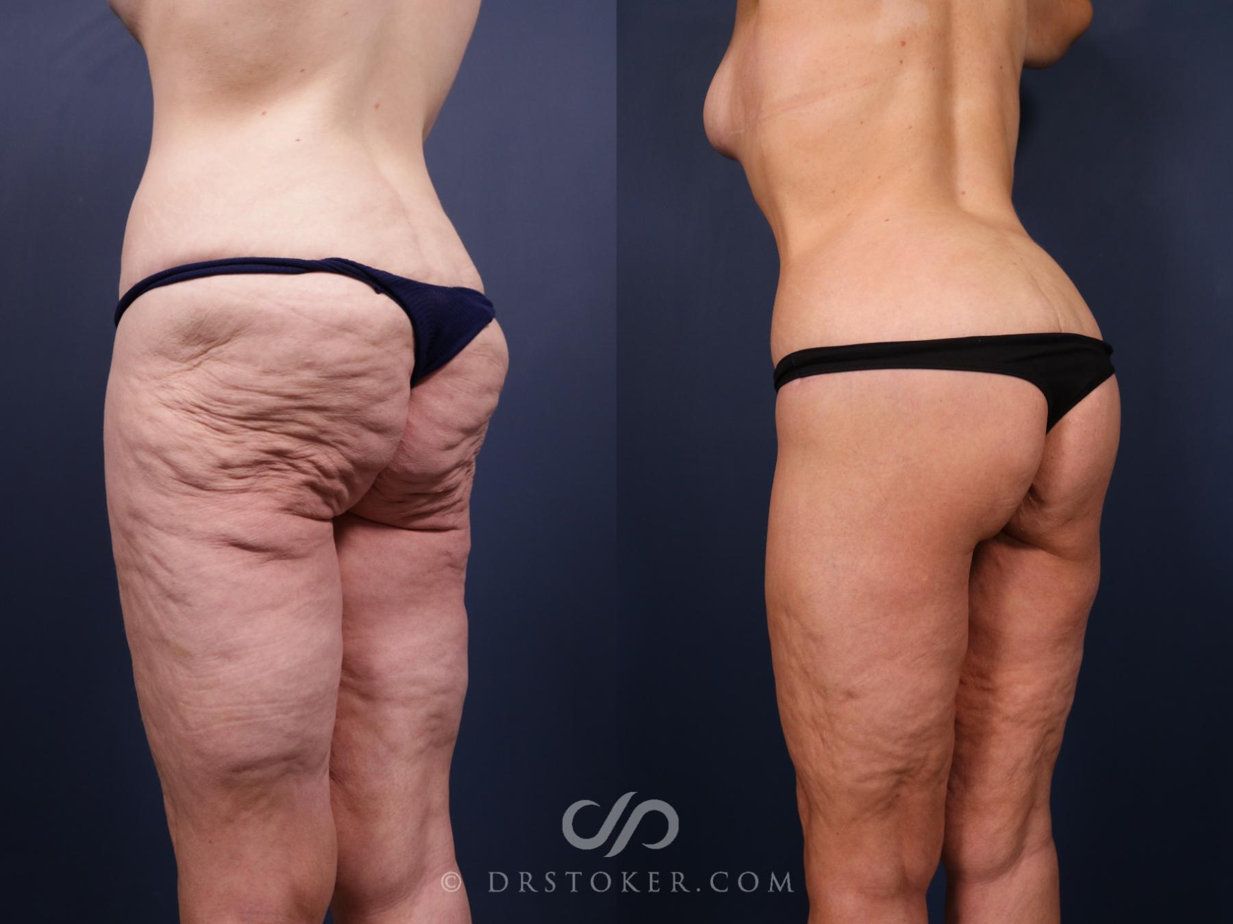Before & After Bikini Body Lift ™ Case 2516 Left Oblique View in Los Angeles, CA