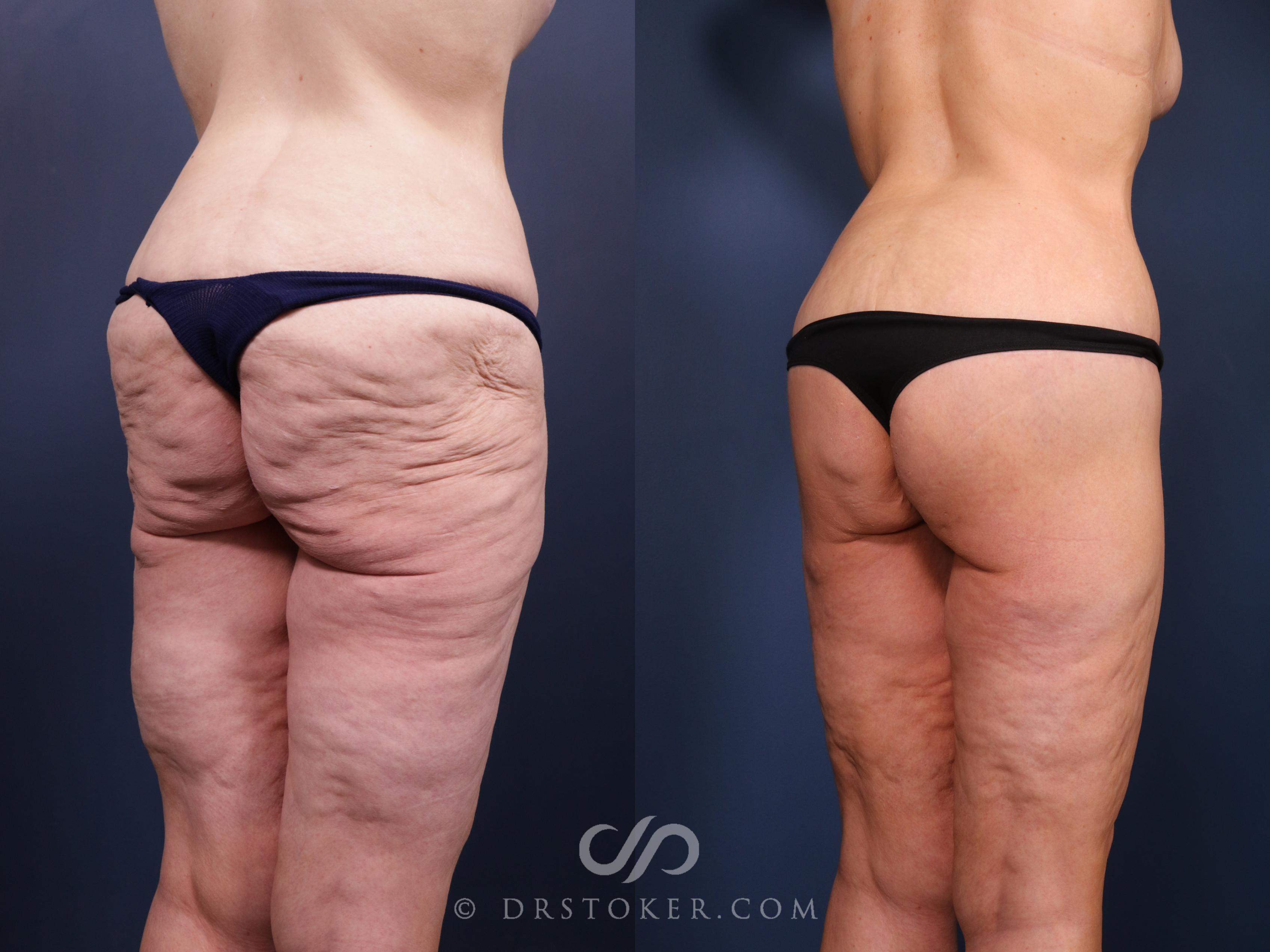 Before & After Bikini Body Lift ™ Case 2516 Right Oblique View in Los Angeles, CA