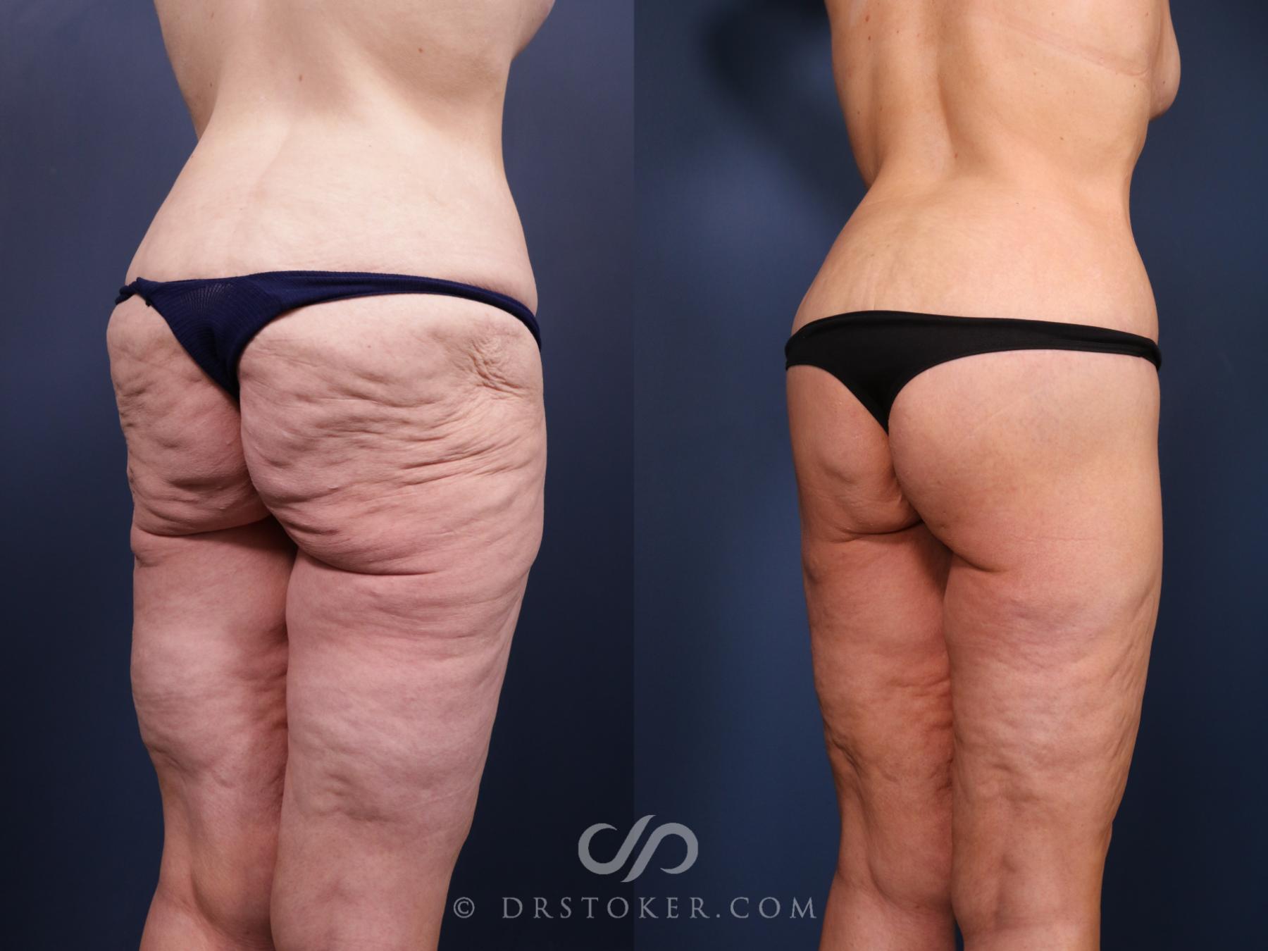 Before & After Bikini Body Lift ™ Case 2516 Right Oblique View in Los Angeles, CA