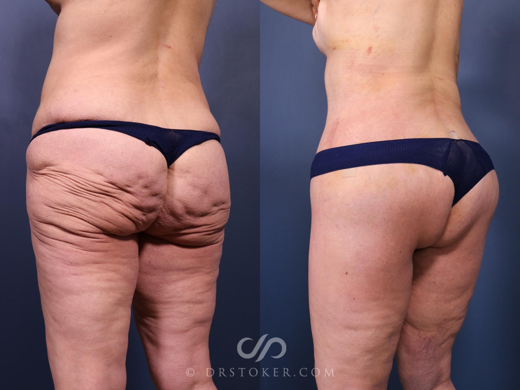 Before & After Bikini Body Lift ™ Case 2521 Left Oblique View in Los Angeles, CA
