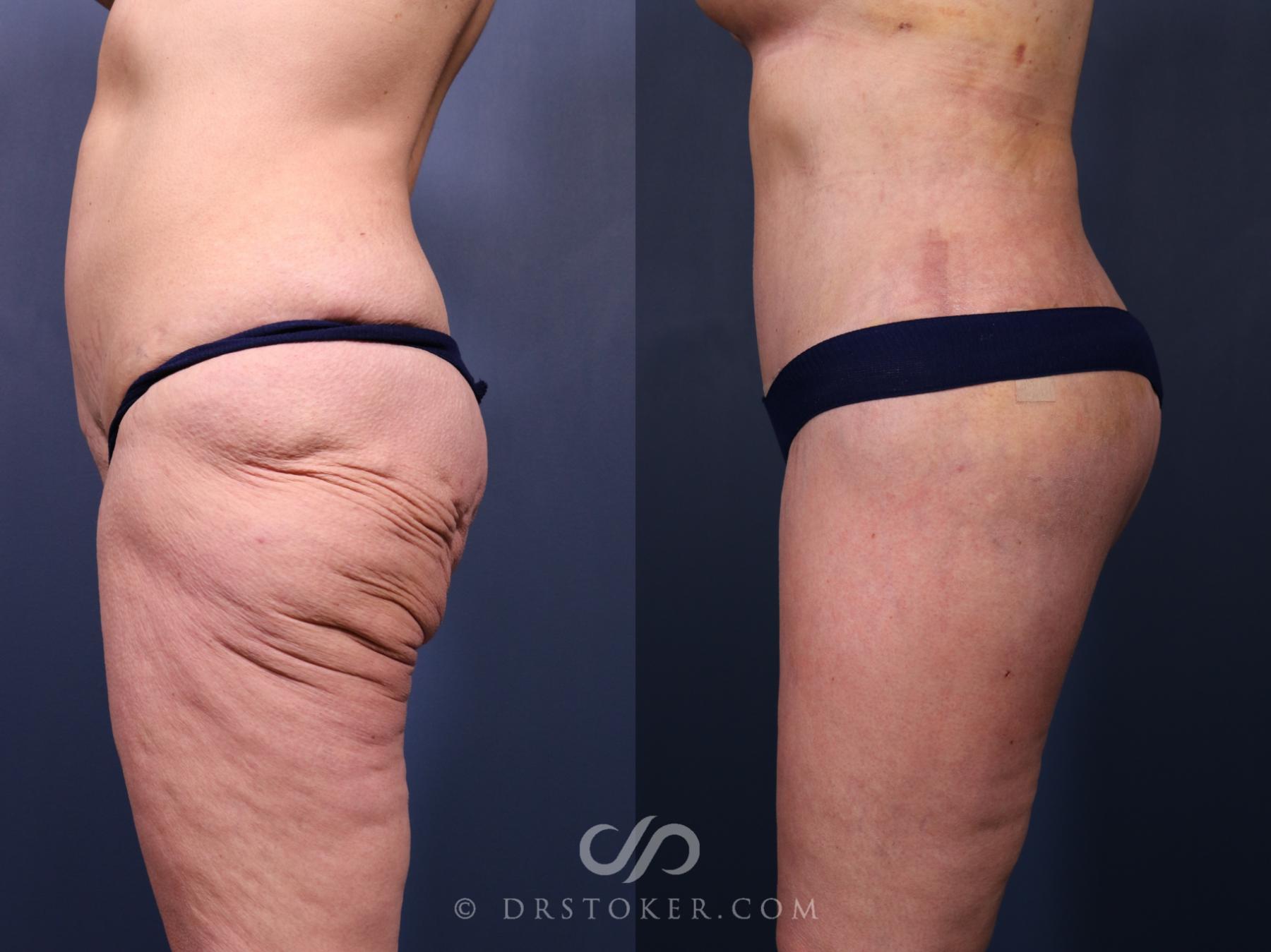 Before & After Bikini Body Lift ™ Case 2521 Left Side View in Los Angeles, CA
