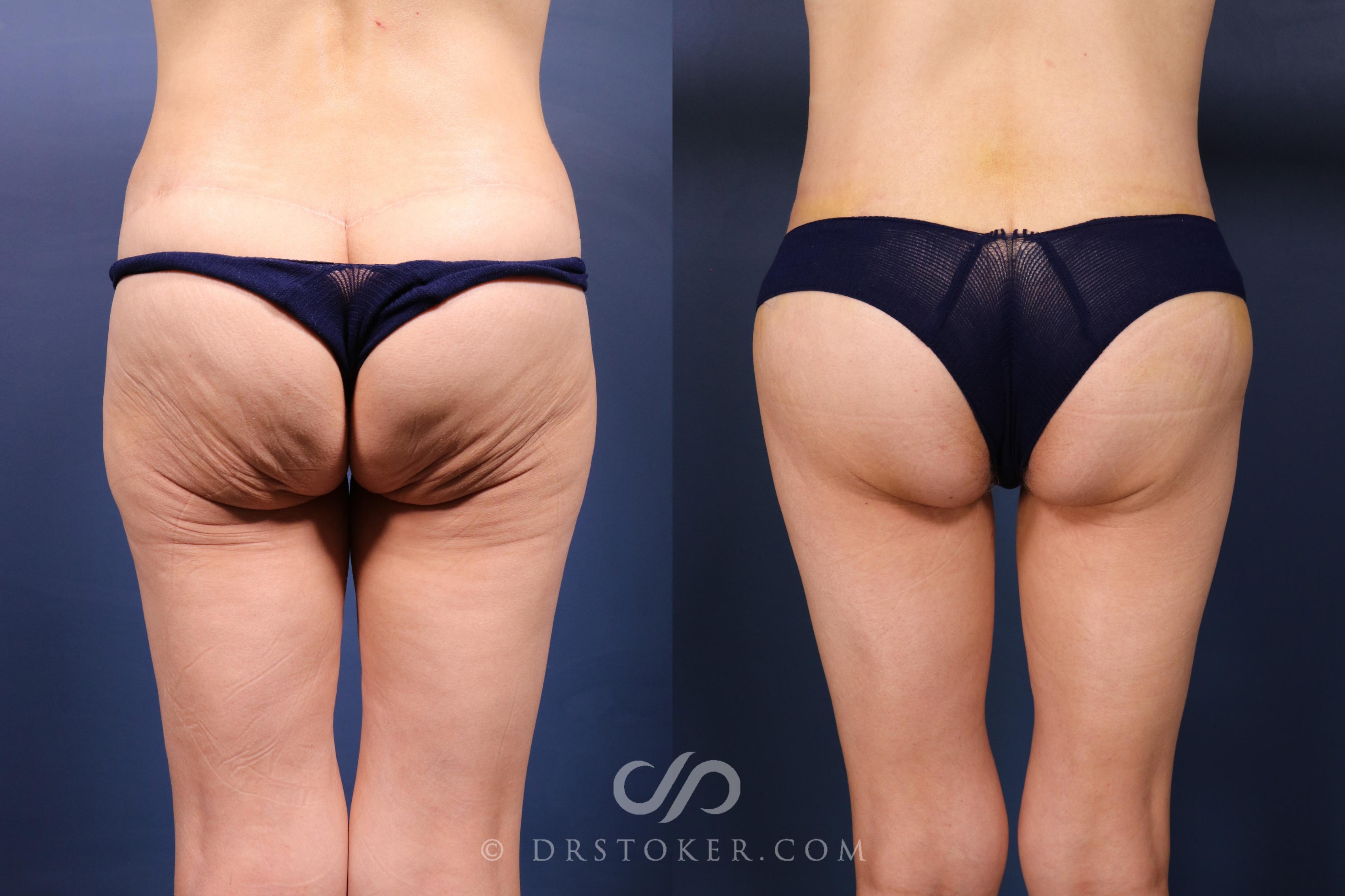 Before & After Bikini Body Lift ™ Case 2568 Back View in Los Angeles, CA