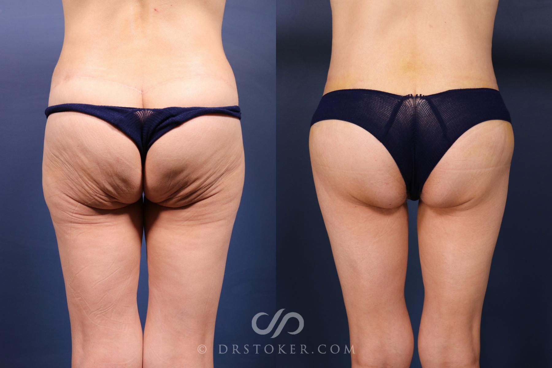 Before & After Bikini Body Lift ™ Case 2568 Back View in Los Angeles, CA