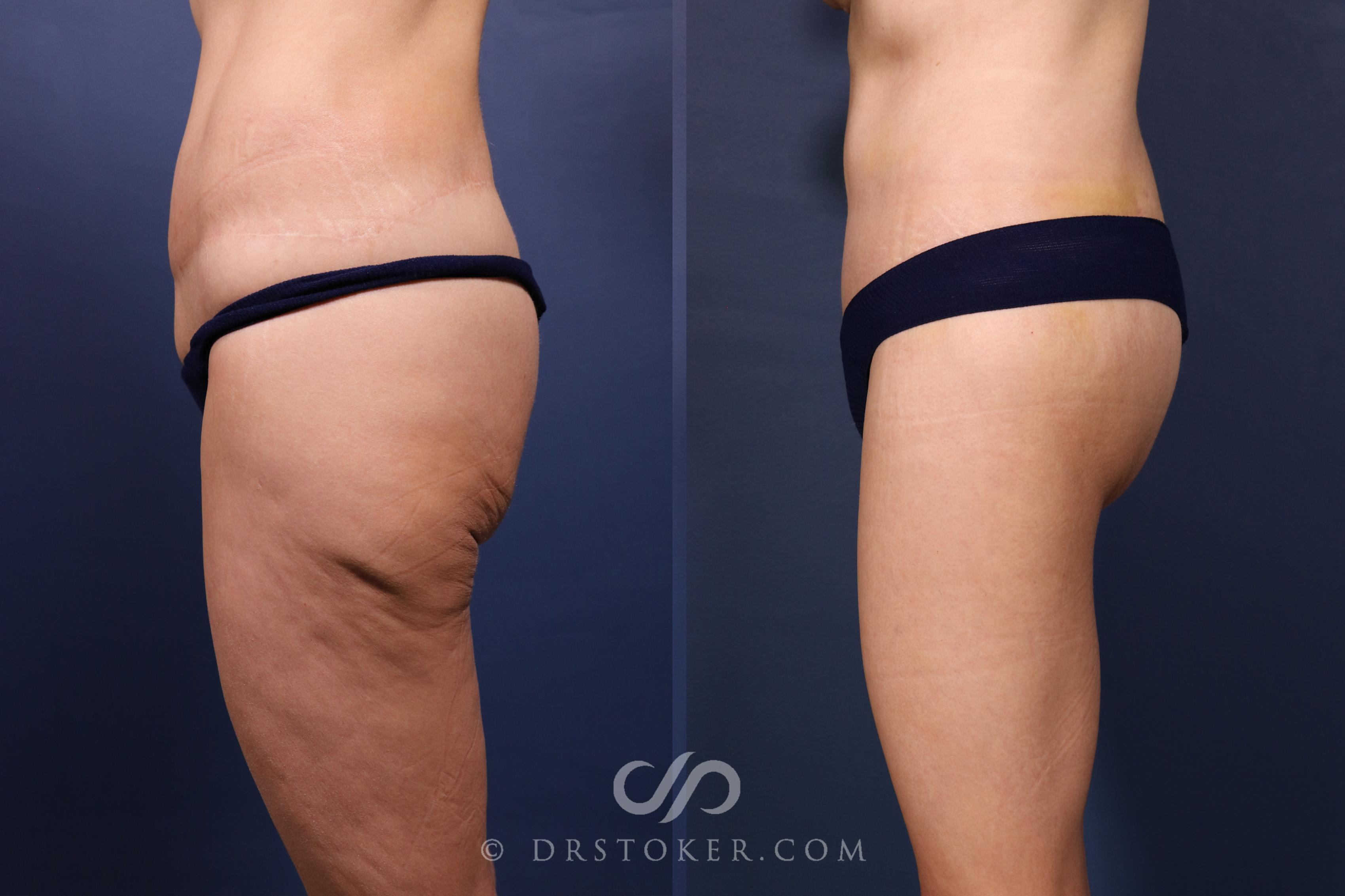 Before & After Bikini Body Lift ™ Case 2568 Left Side View in Los Angeles, CA