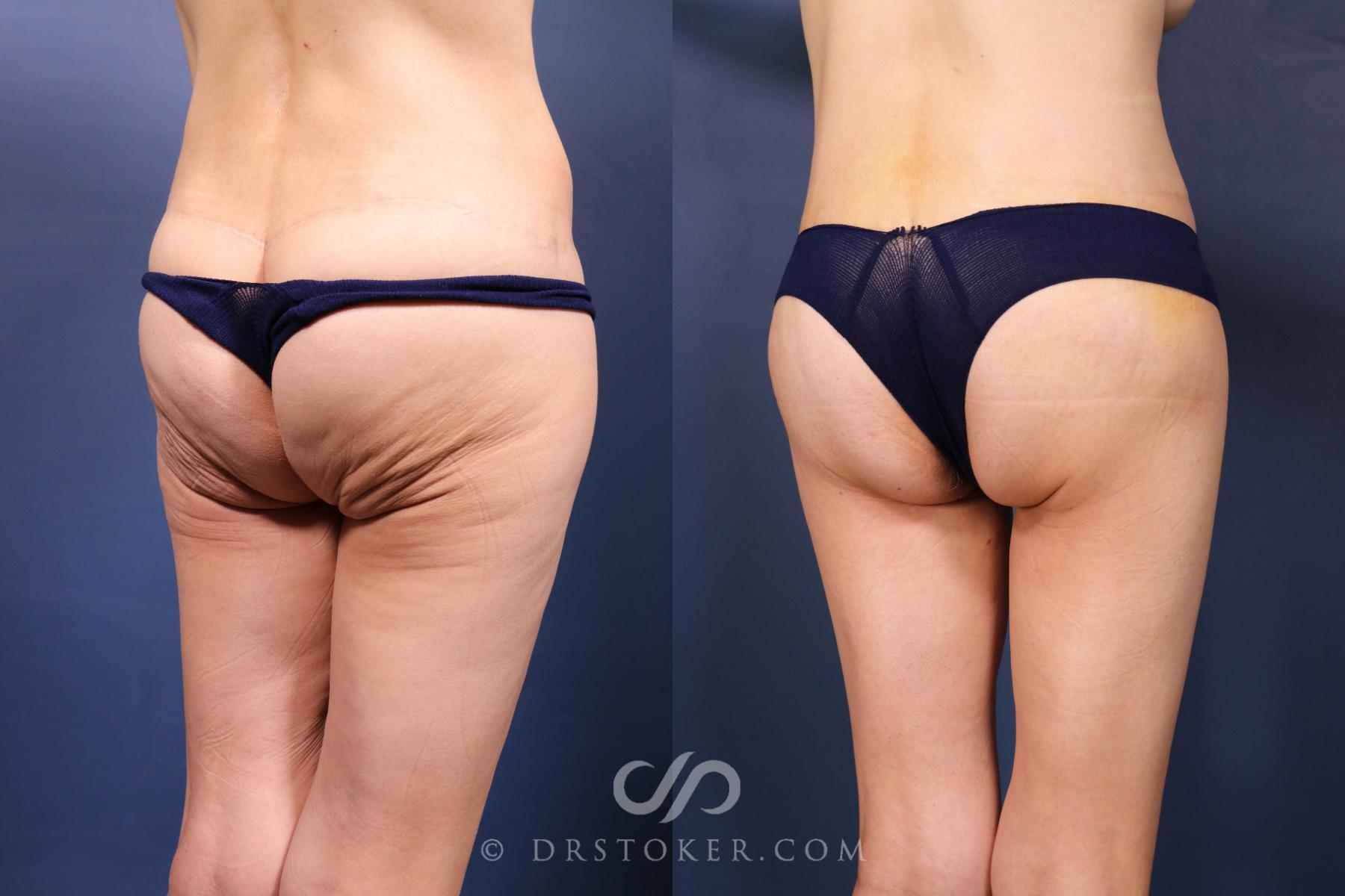 Before & After Bikini Body Lift ™ Case 2568 Right Oblique View in Los Angeles, CA