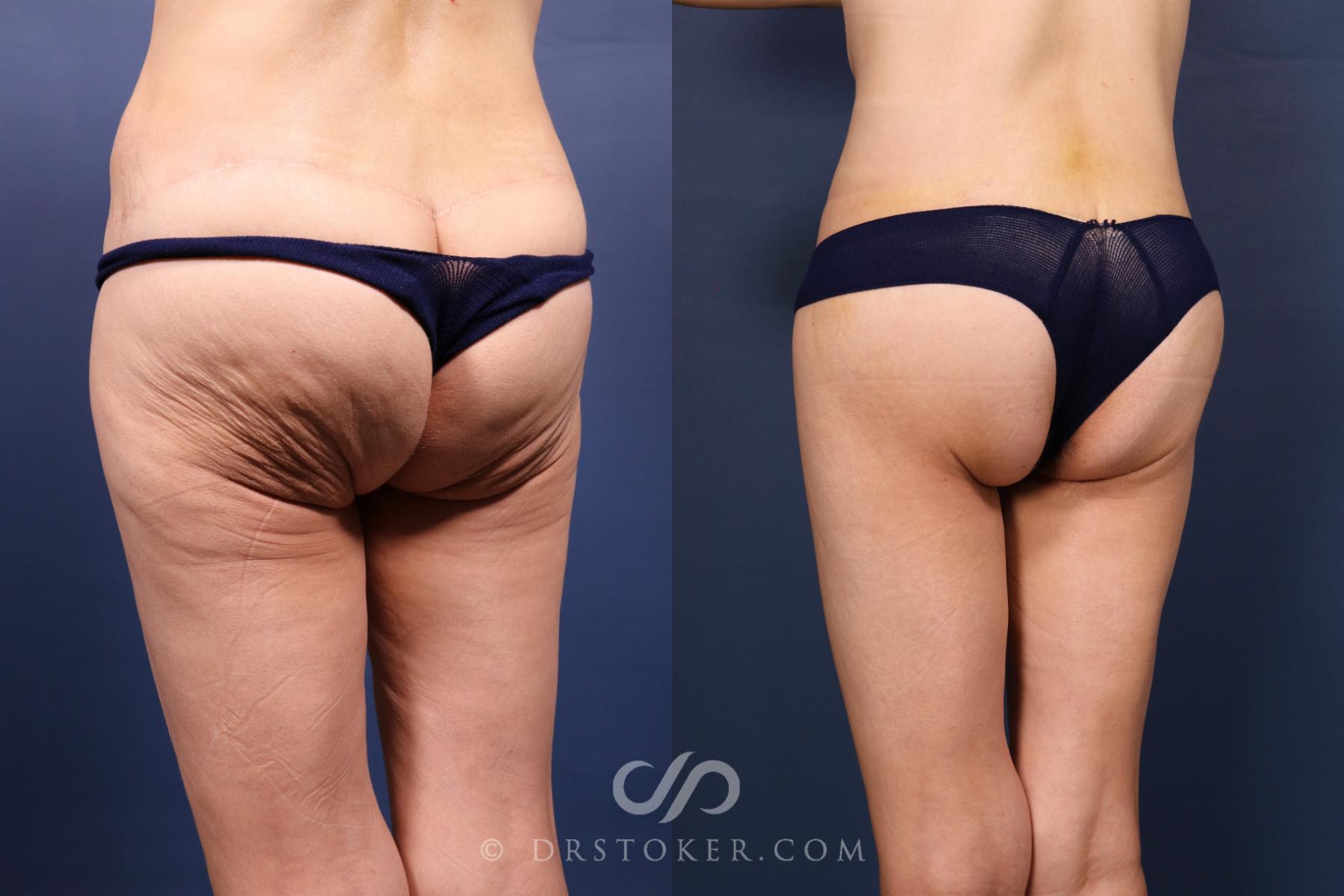 Before & After Bikini Body Lift ™ Case 2569 Left Oblique View in Los Angeles, CA