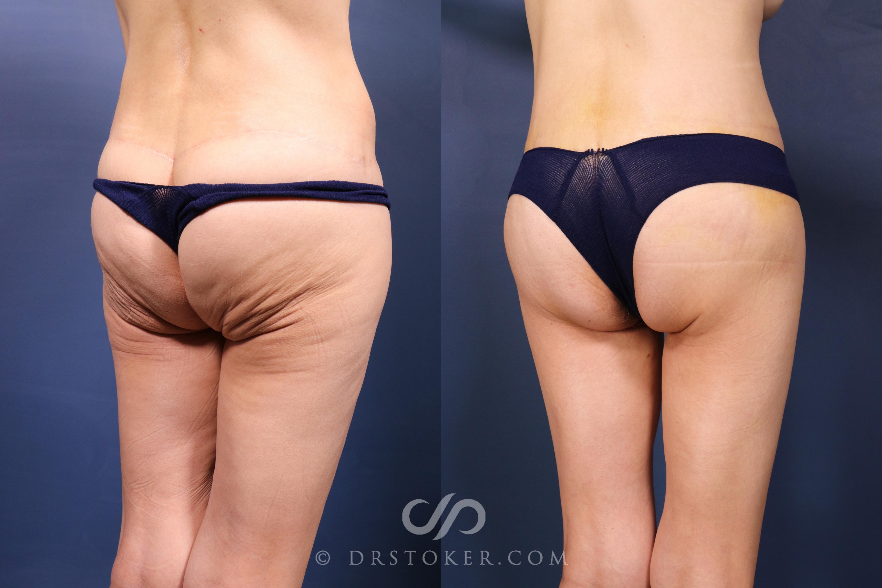 Before & After Bikini Body Lift ™ Case 2569 Right Oblique View in Los Angeles, CA