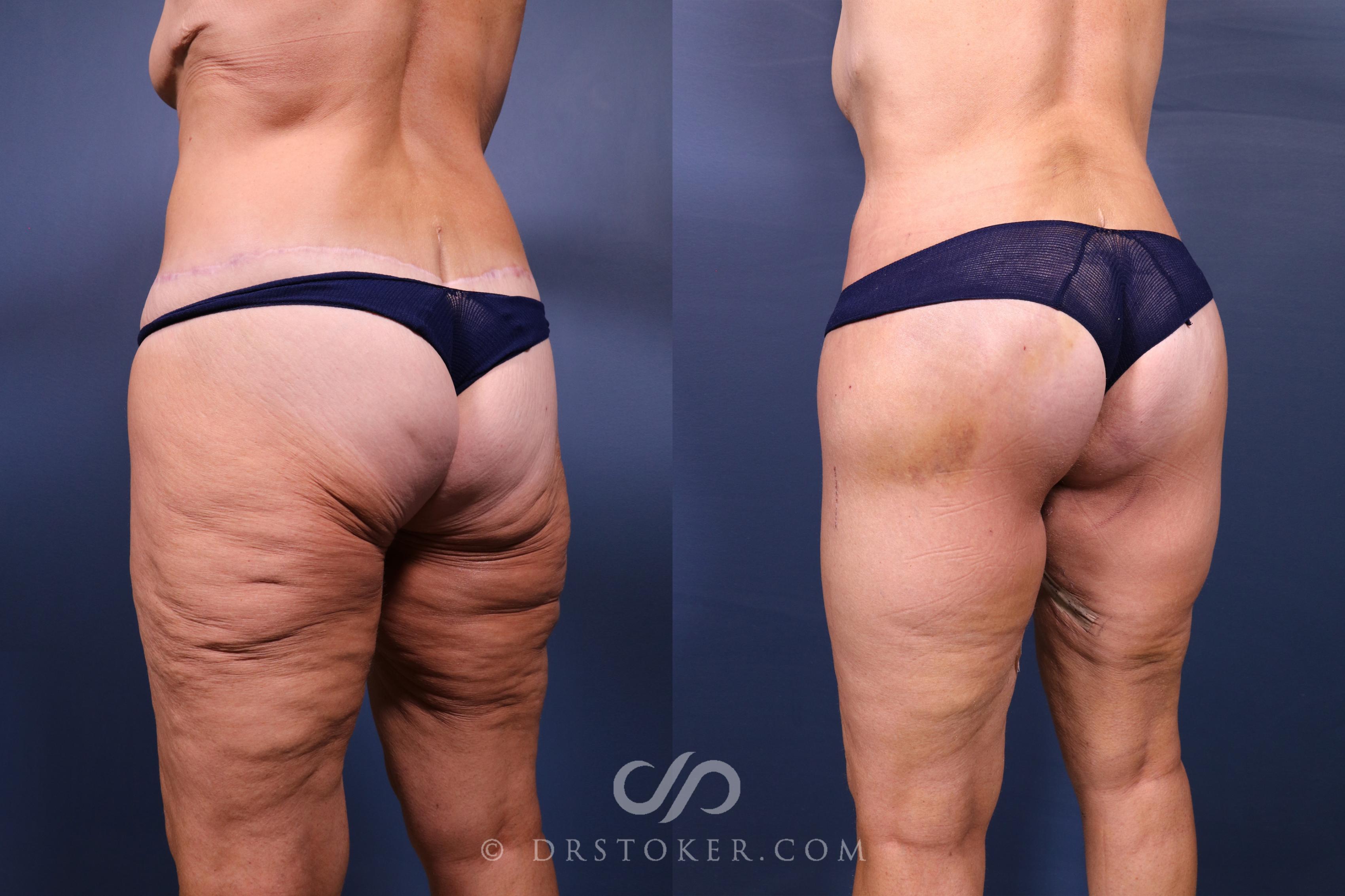 Before & After Bikini Body Lift ™ Case 2598 Left Oblique View in Los Angeles, CA