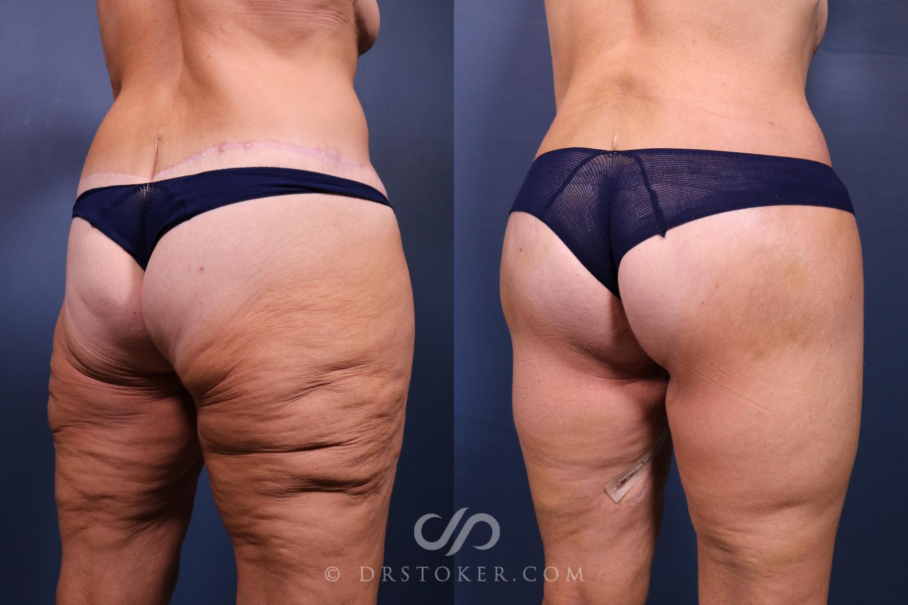 Before & After Bikini Body Lift ™ Case 2598 Right Oblique View in Los Angeles, CA