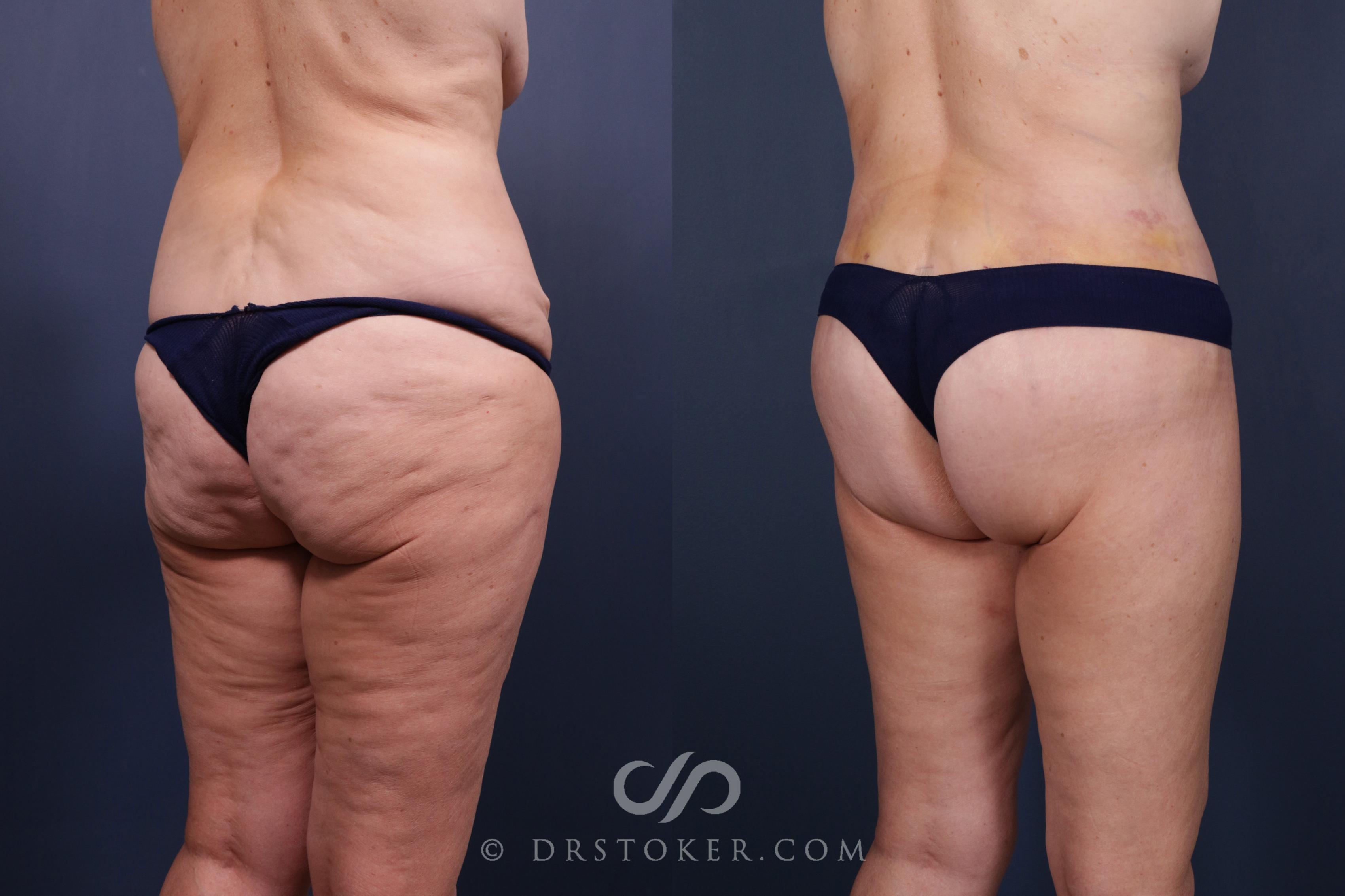 Before & After Bikini Body Lift ™ Case 2606 Right Oblique View in Los Angeles, CA