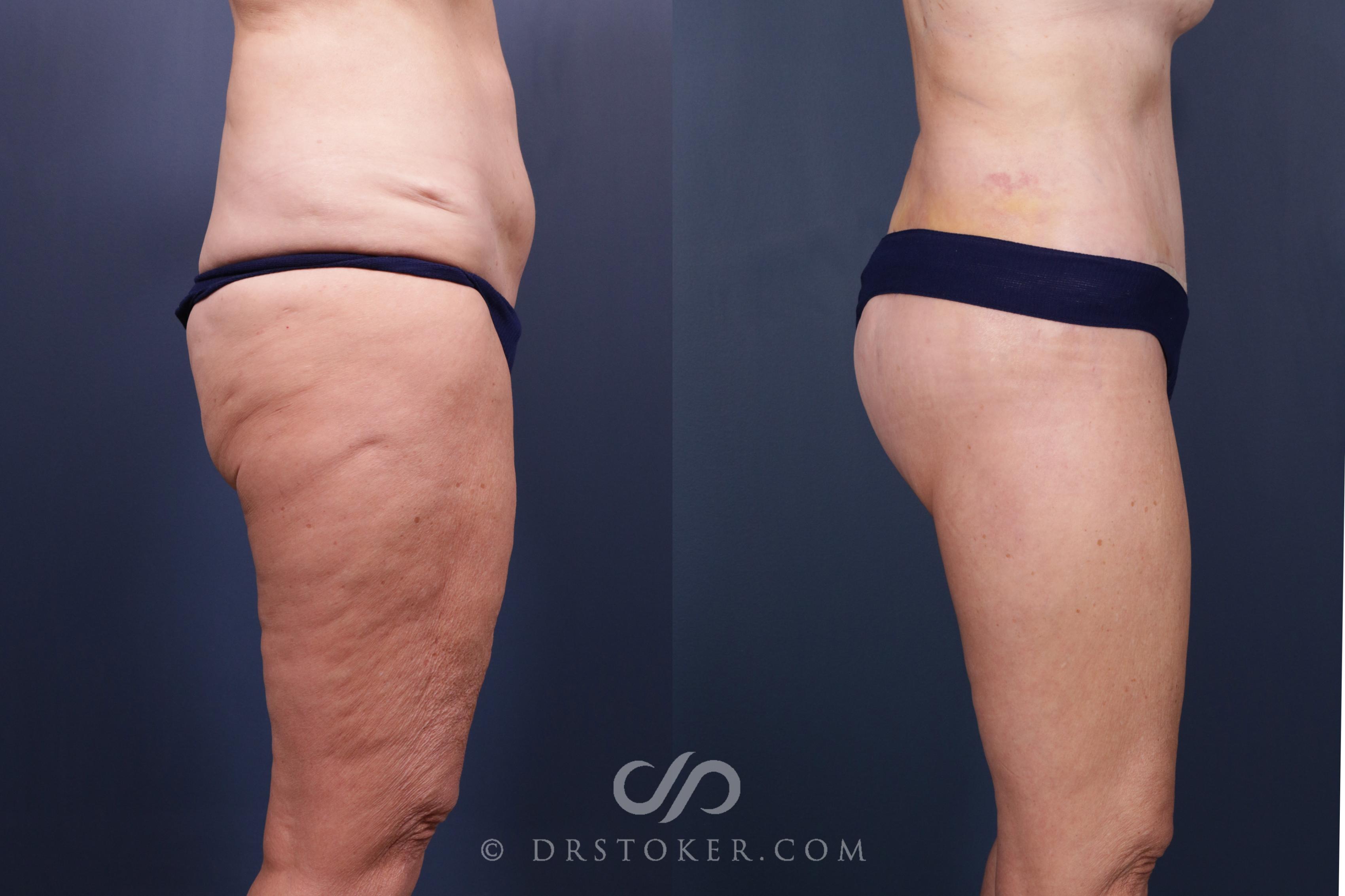 Before & After Bikini Body Lift ™ Case 2606 Right Side View in Los Angeles, CA
