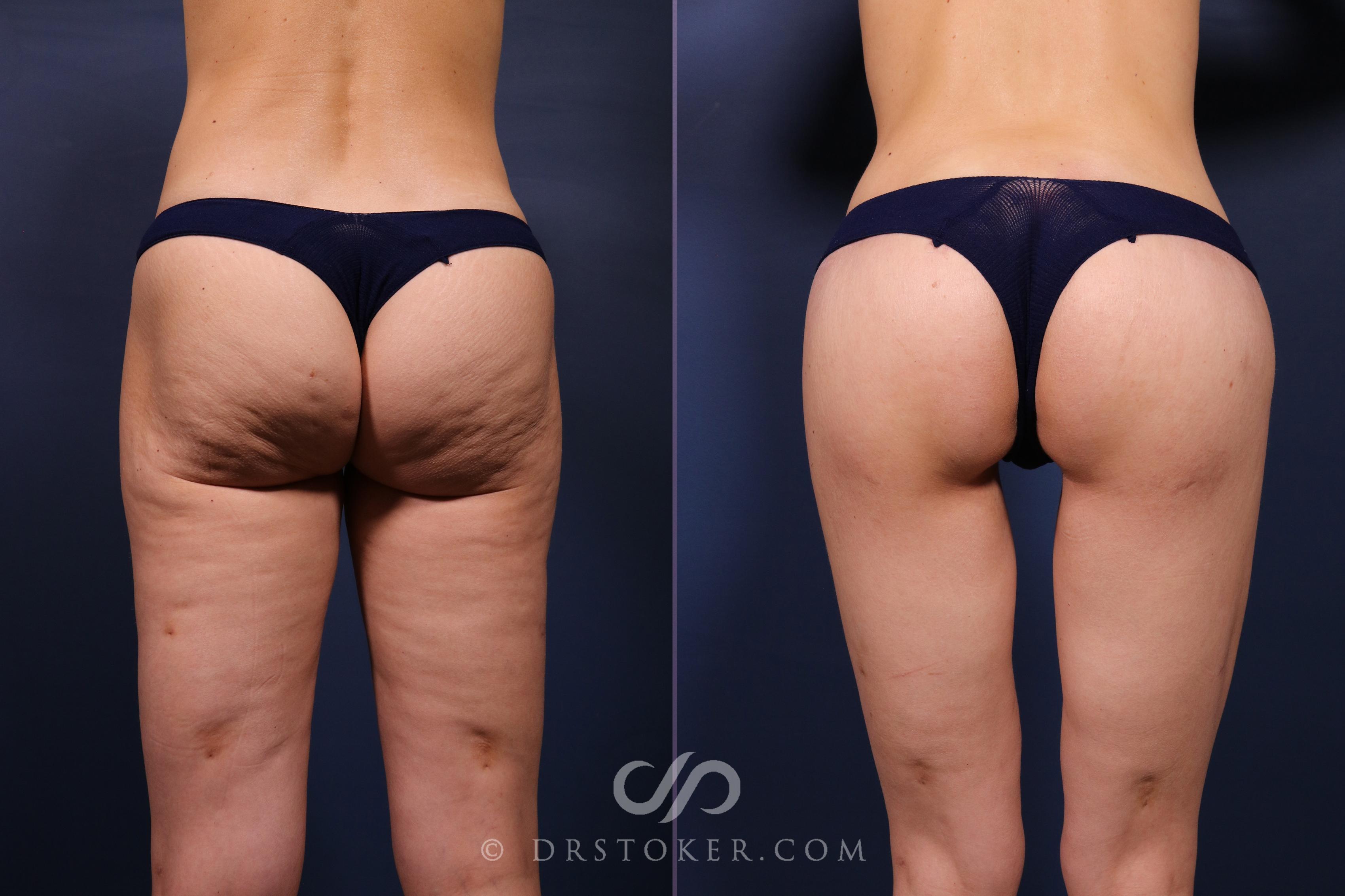 Before & After Bikini Body Lift ™ Case 2607 Back View in Los Angeles, CA