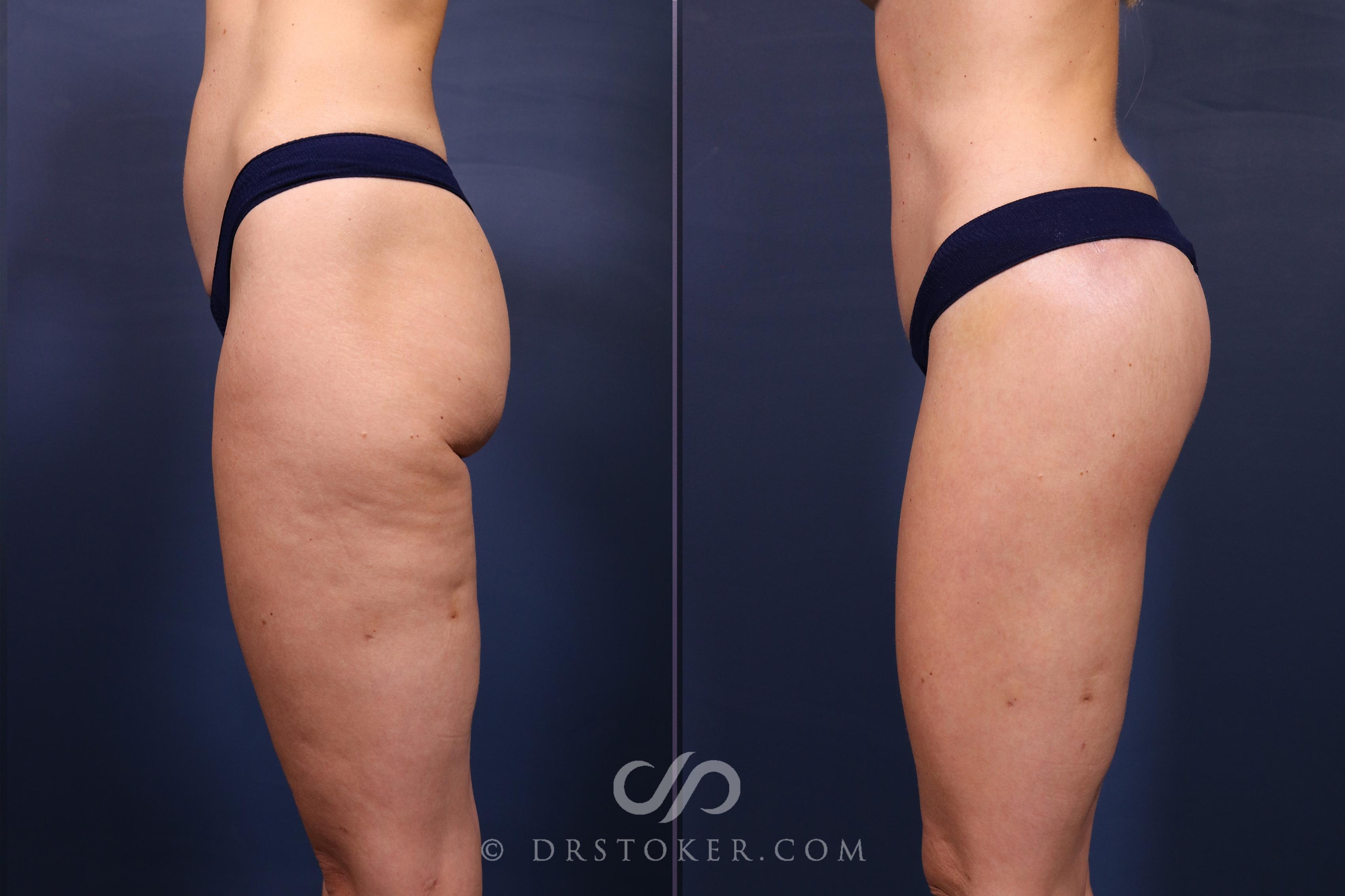 Before & After Bikini Body Lift ™ Case 2607 Left Side View in Los Angeles, CA