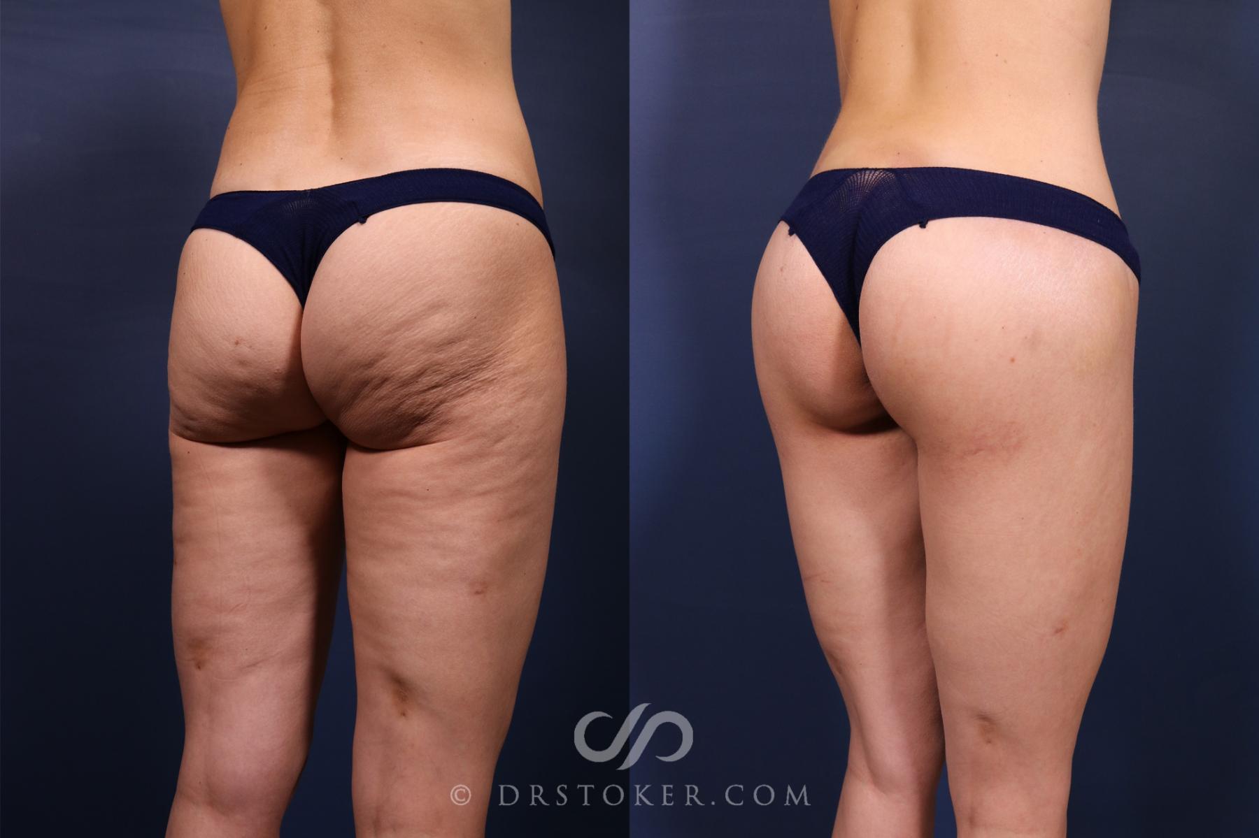 Before & After Bikini Body Lift ™ Case 2607 Right Oblique View in Los Angeles, CA