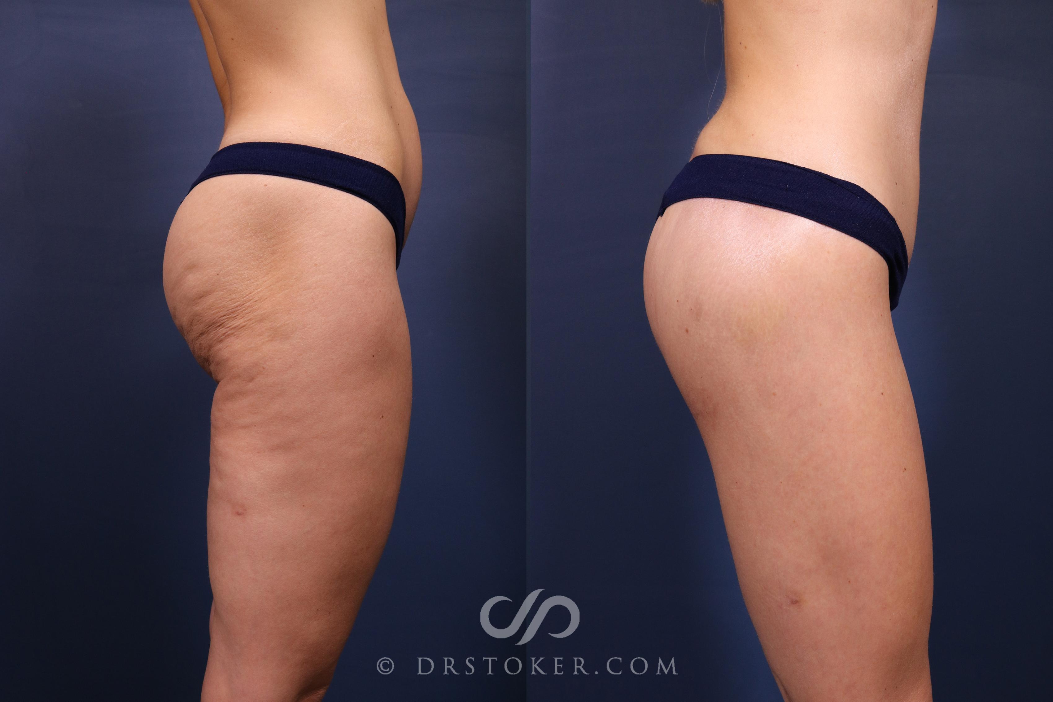 Before & After Bikini Body Lift ™ Case 2607 Right Side View in Los Angeles, CA