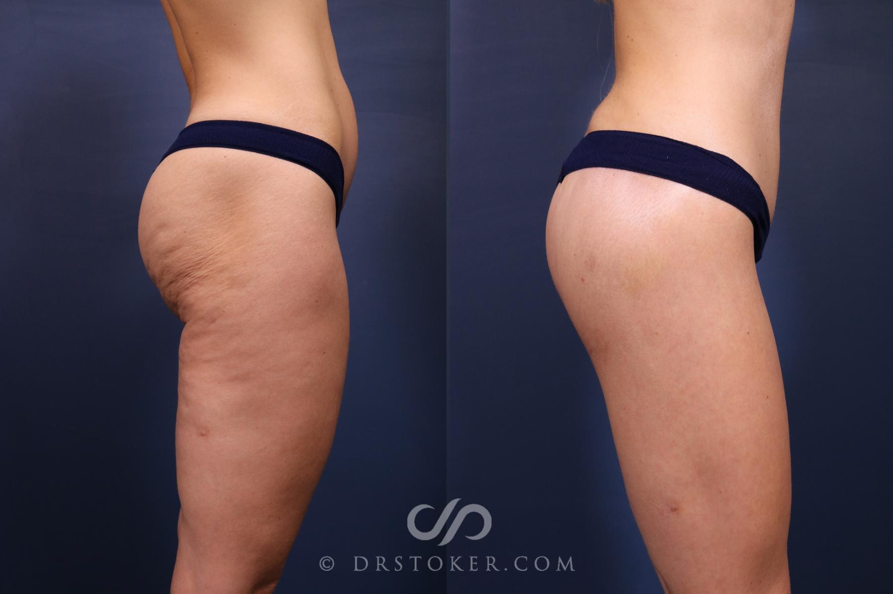 Before & After Bikini Body Lift ™ Case 2607 Right Side View in Los Angeles, CA
