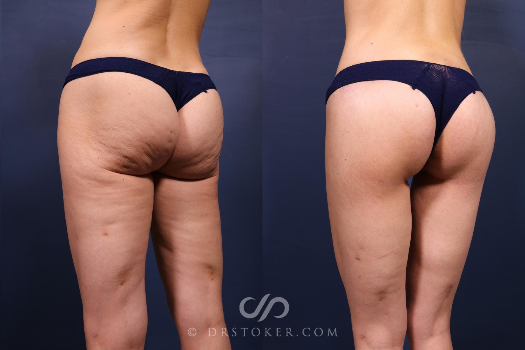 Before & After Bikini Body Lift ™ Case 2609 Left Oblique View in Los Angeles, CA