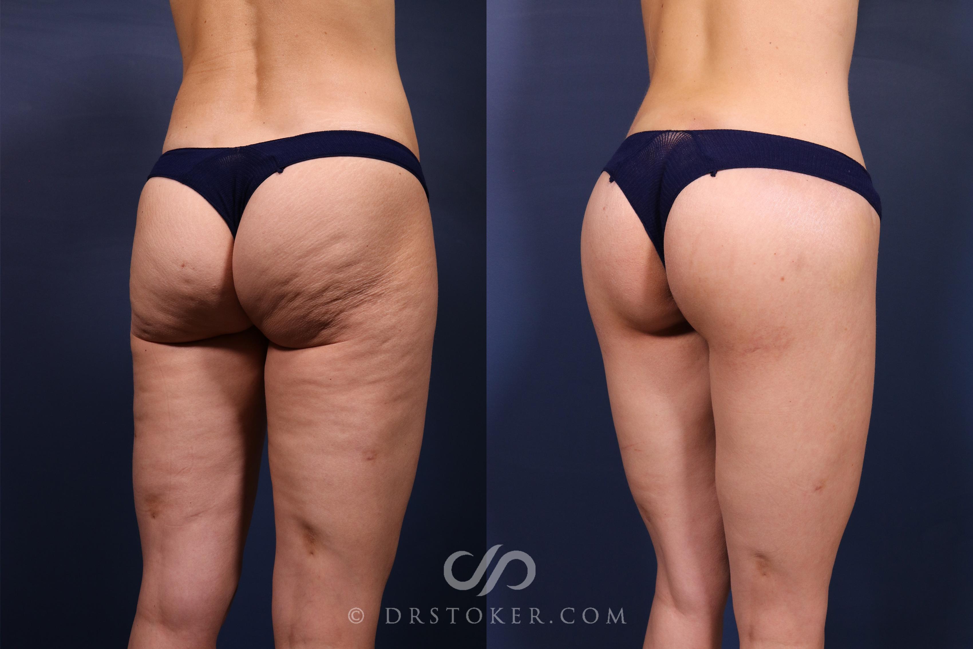 Before & After Bikini Body Lift ™ Case 2609 Right Oblique View in Los Angeles, CA