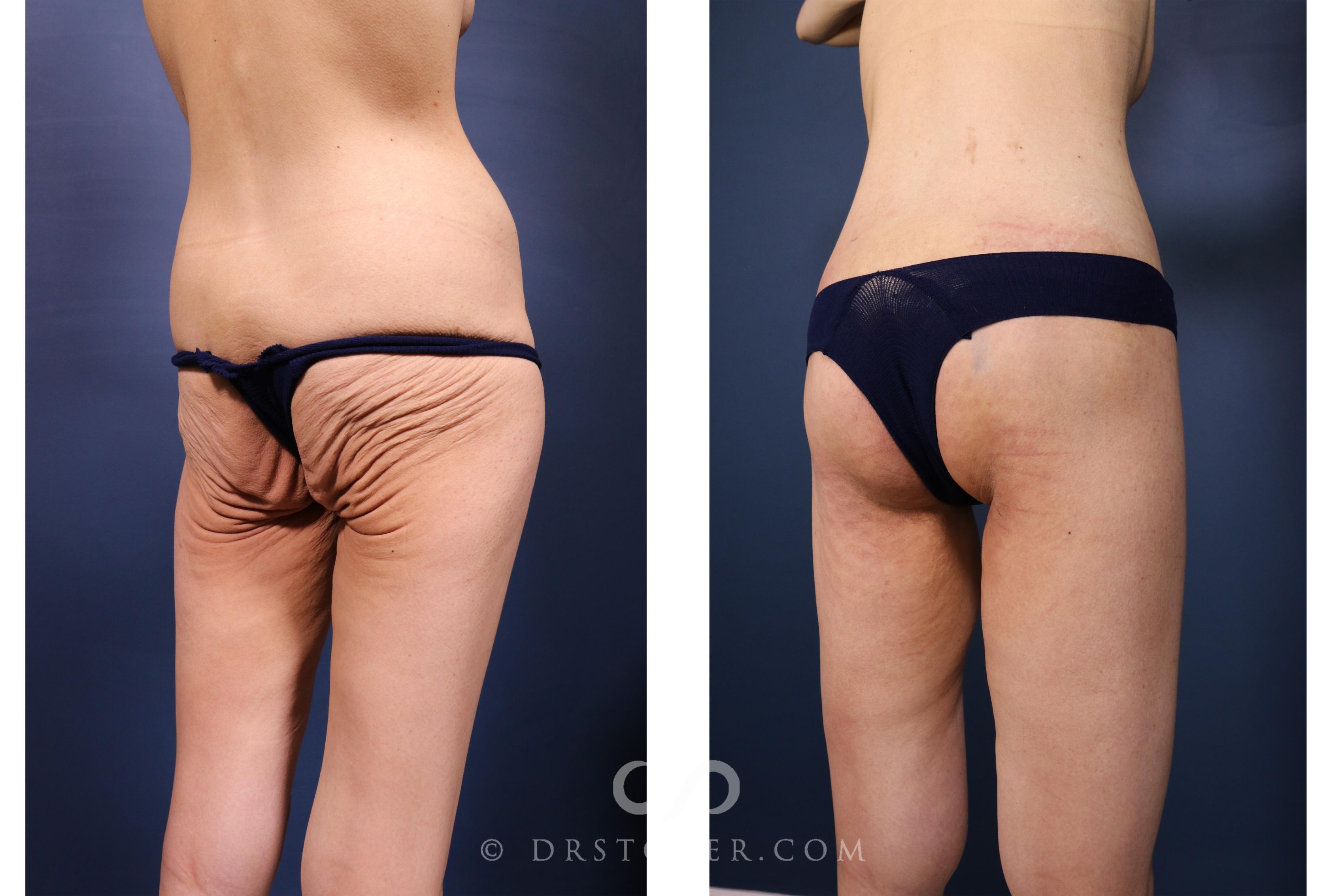 Before & After Bikini Body Lift ™ Case 2612 Right Oblique View in Los Angeles, CA