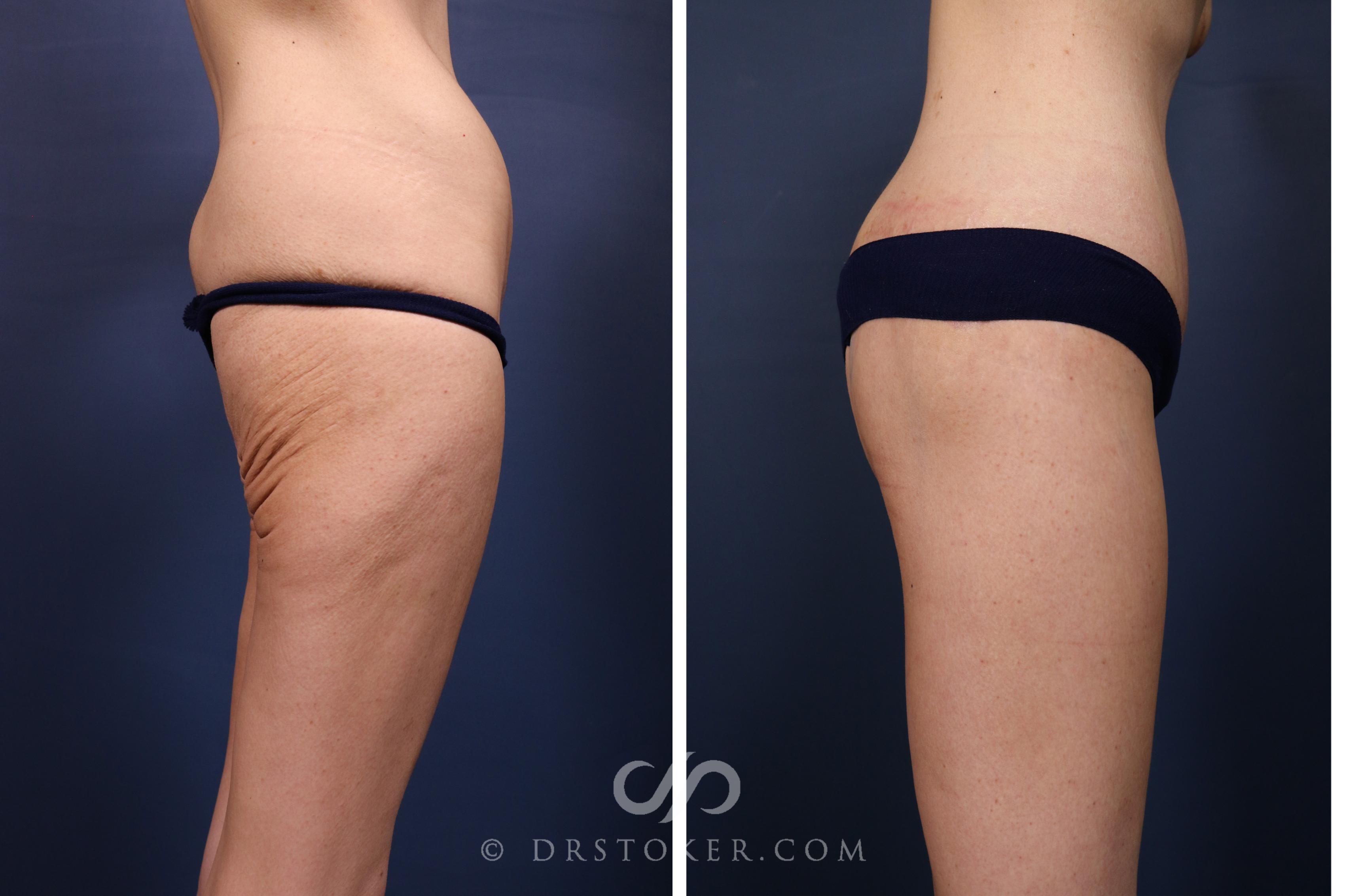 Before & After Bikini Body Lift ™ Case 2612 Right Side View in Los Angeles, CA