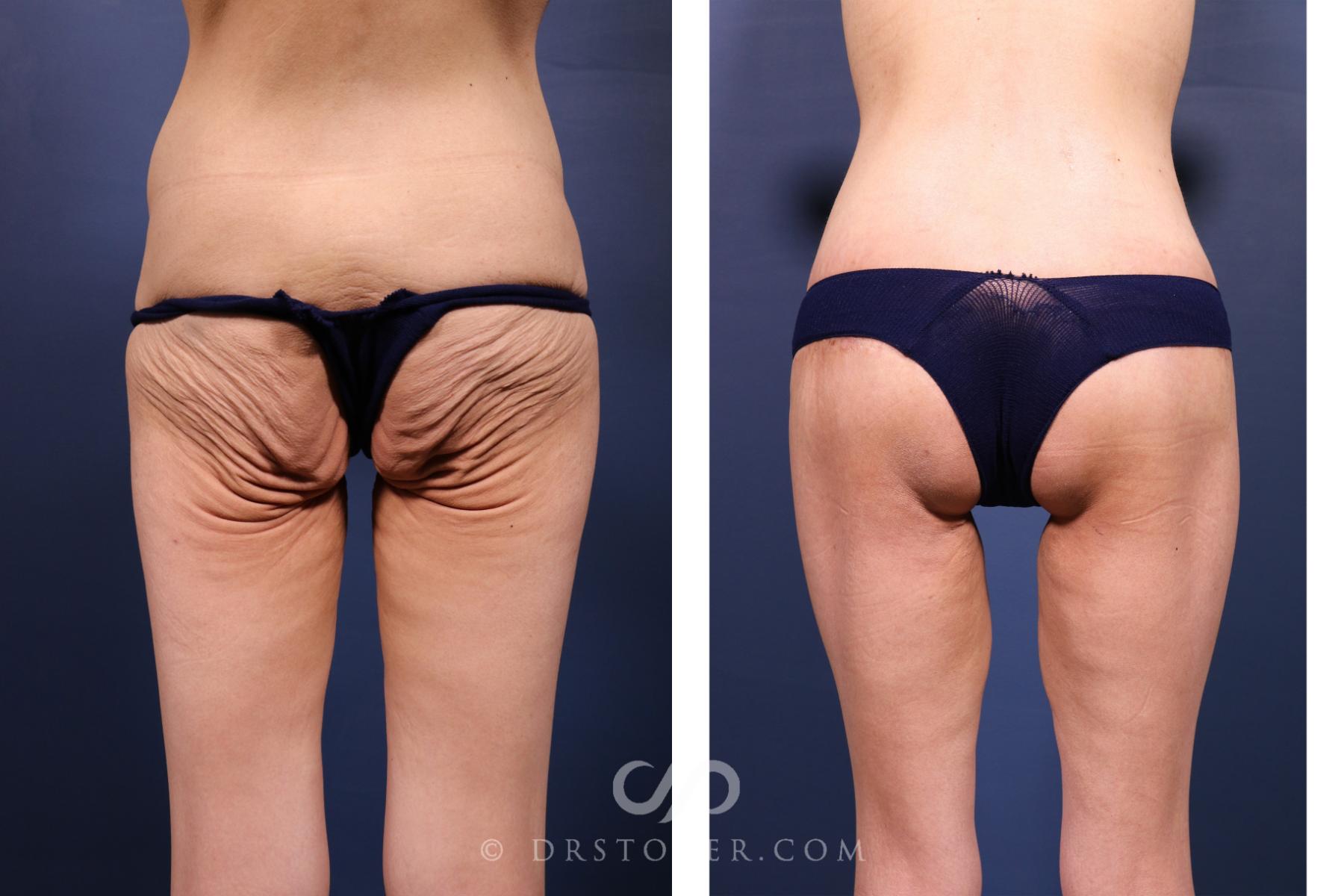 Before & After Bikini Body Lift ™ Case 2628 Back View in Los Angeles, CA