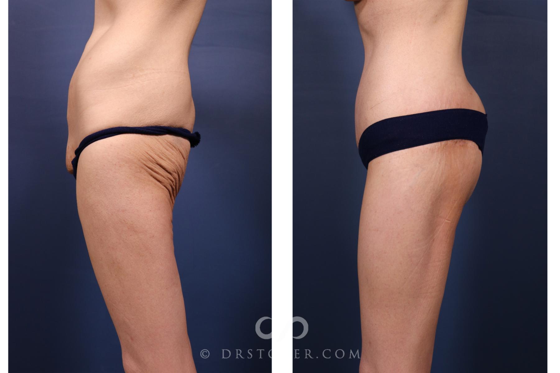 Before & After Bikini Body Lift ™ Case 2628 Left Side View in Los Angeles, CA