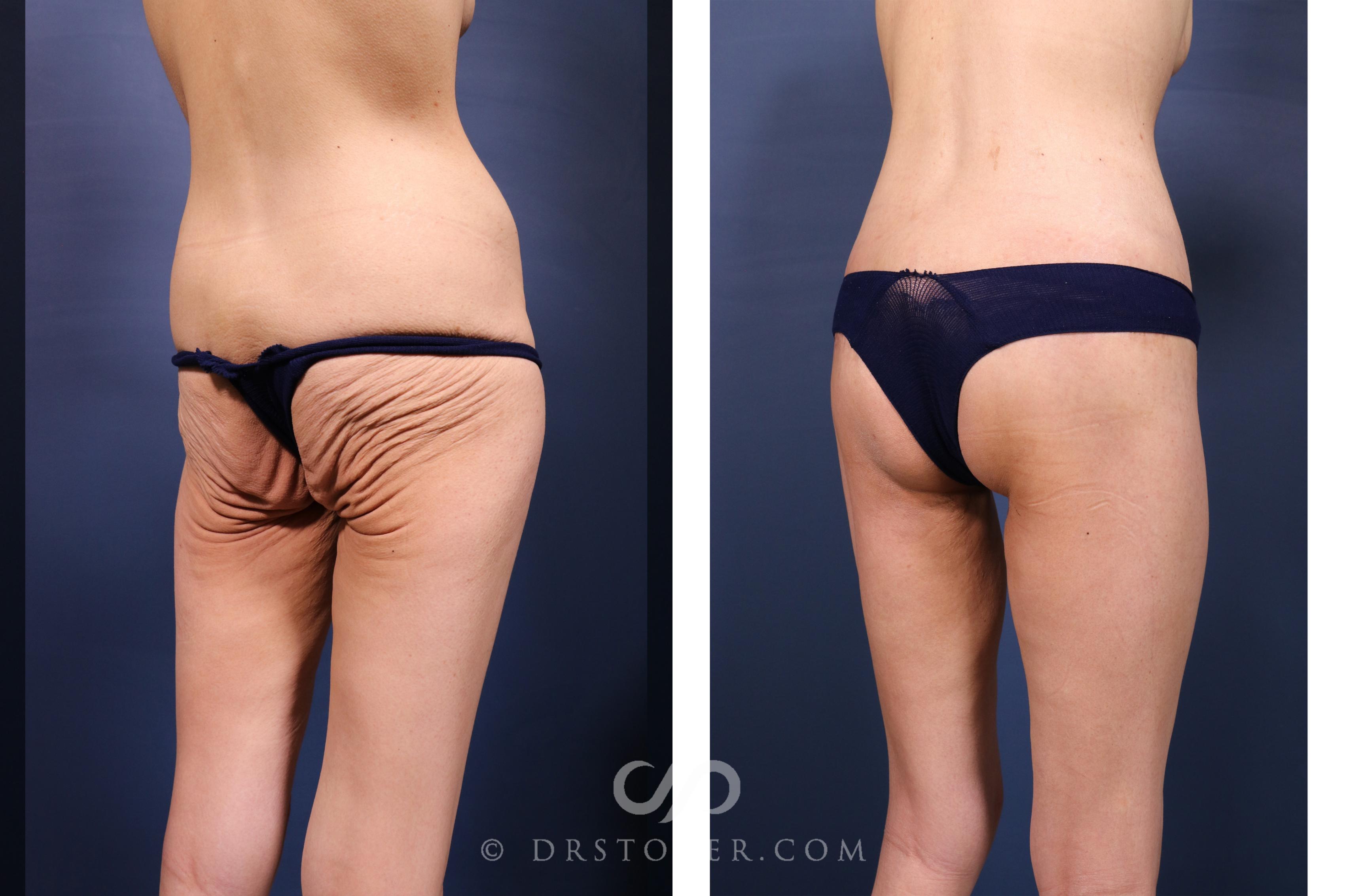 Before & After Bikini Body Lift ™ Case 2628 Right Oblique View in Los Angeles, CA