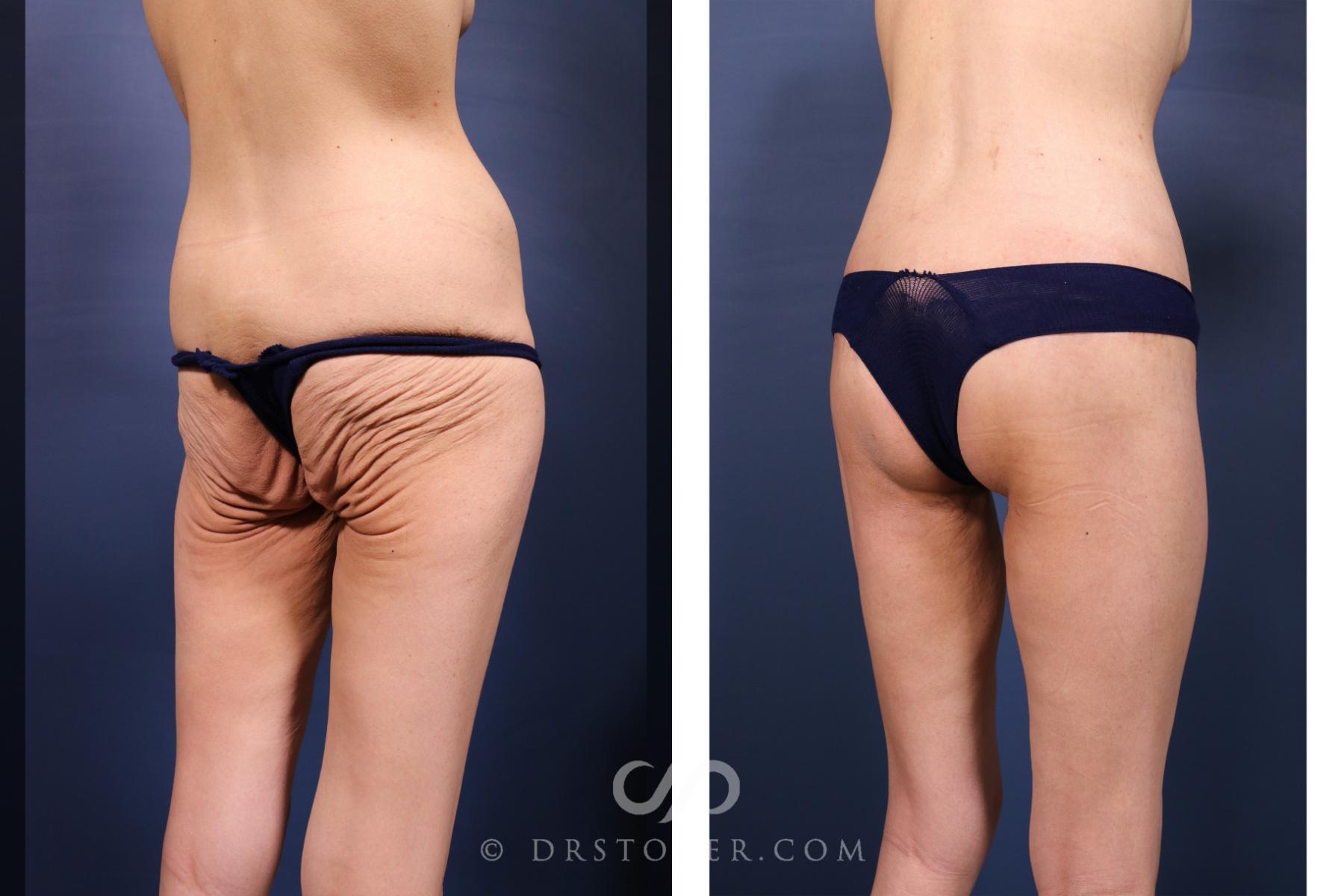 Before & After Bikini Body Lift ™ Case 2628 Right Oblique View in Los Angeles, CA