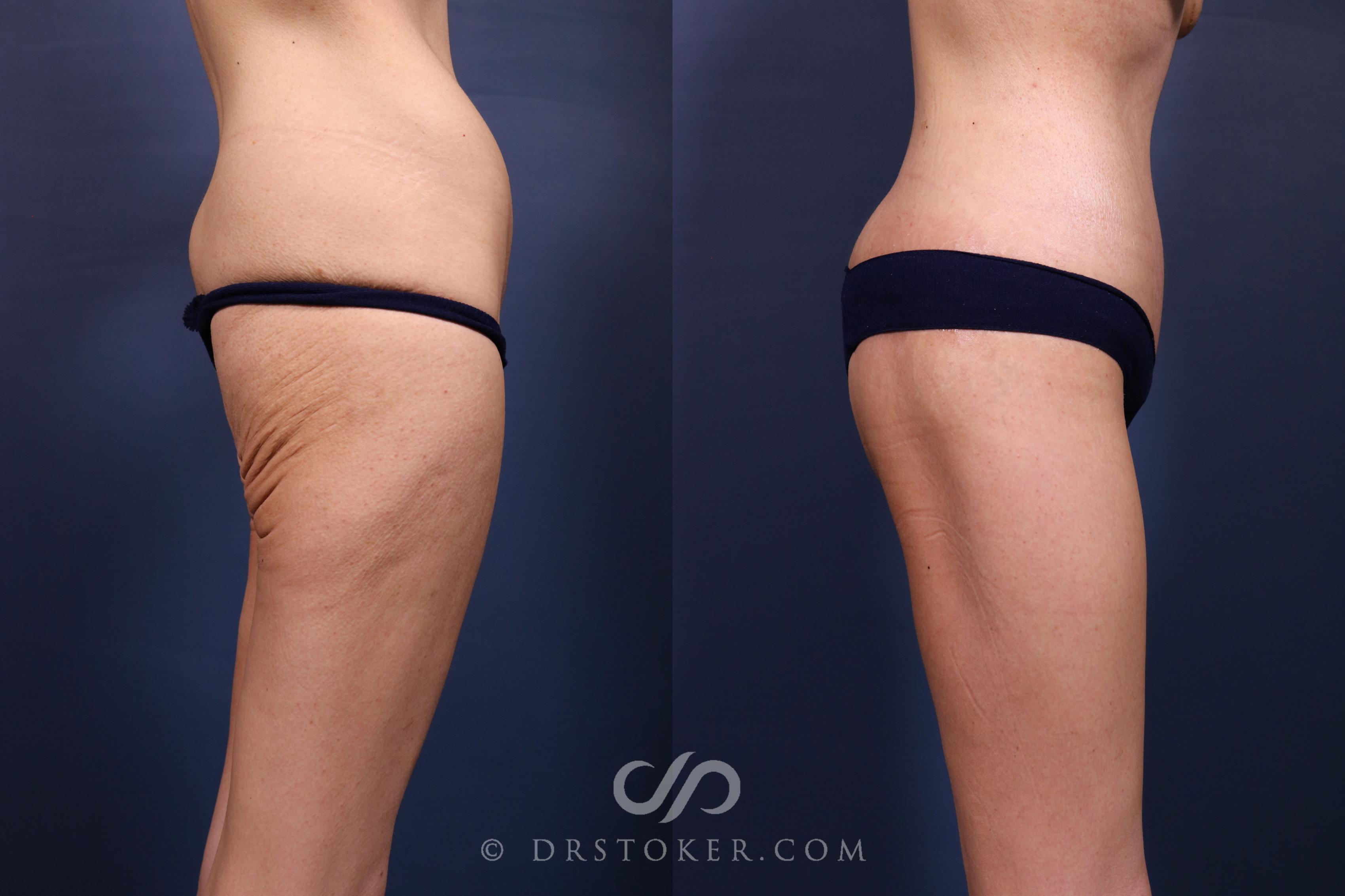 Before & After Bikini Body Lift ™ Case 2628 Right Side View in Los Angeles, CA