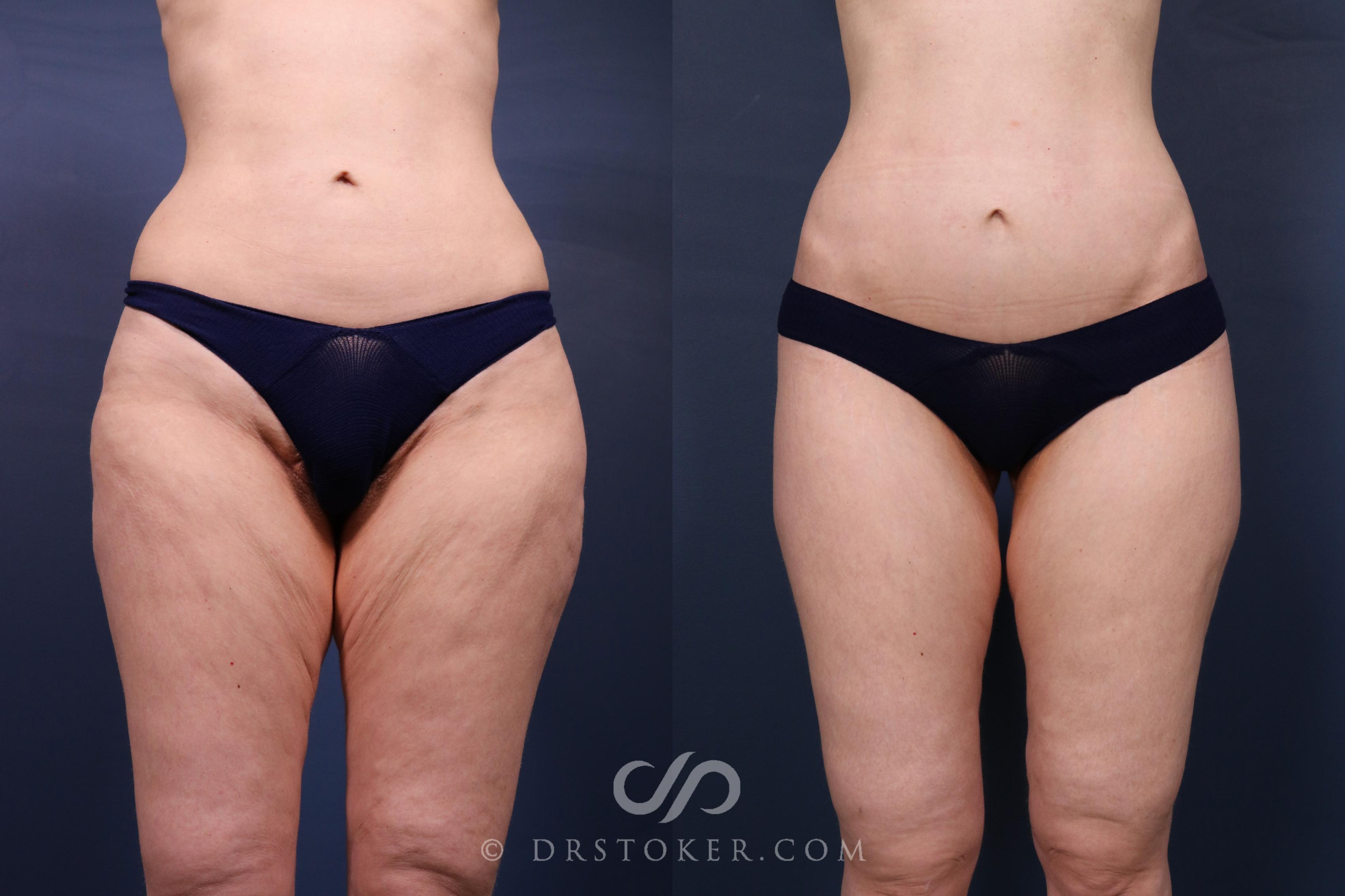 Before & After Bikini Body Lift ™ Case 2633 Front View in Los Angeles, CA