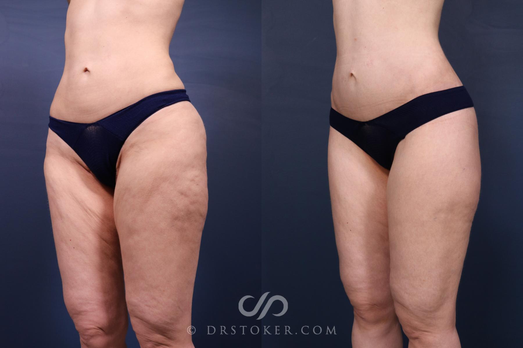 Before & After Bikini Body Lift ™ Case 2633 Front Left Oblique View in Los Angeles, CA