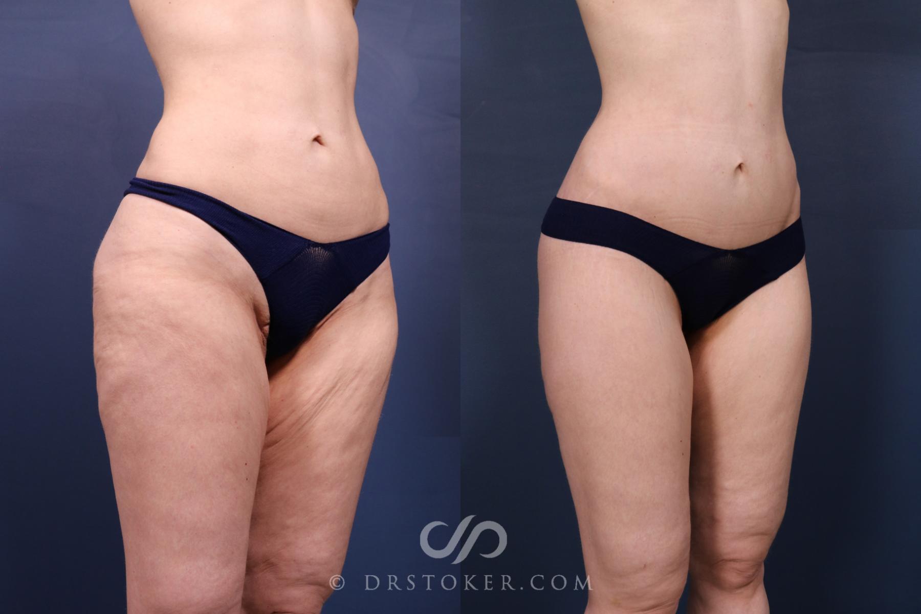 Before & After Bikini Body Lift ™ Case 2633 Front Right Oblique View in Los Angeles, CA